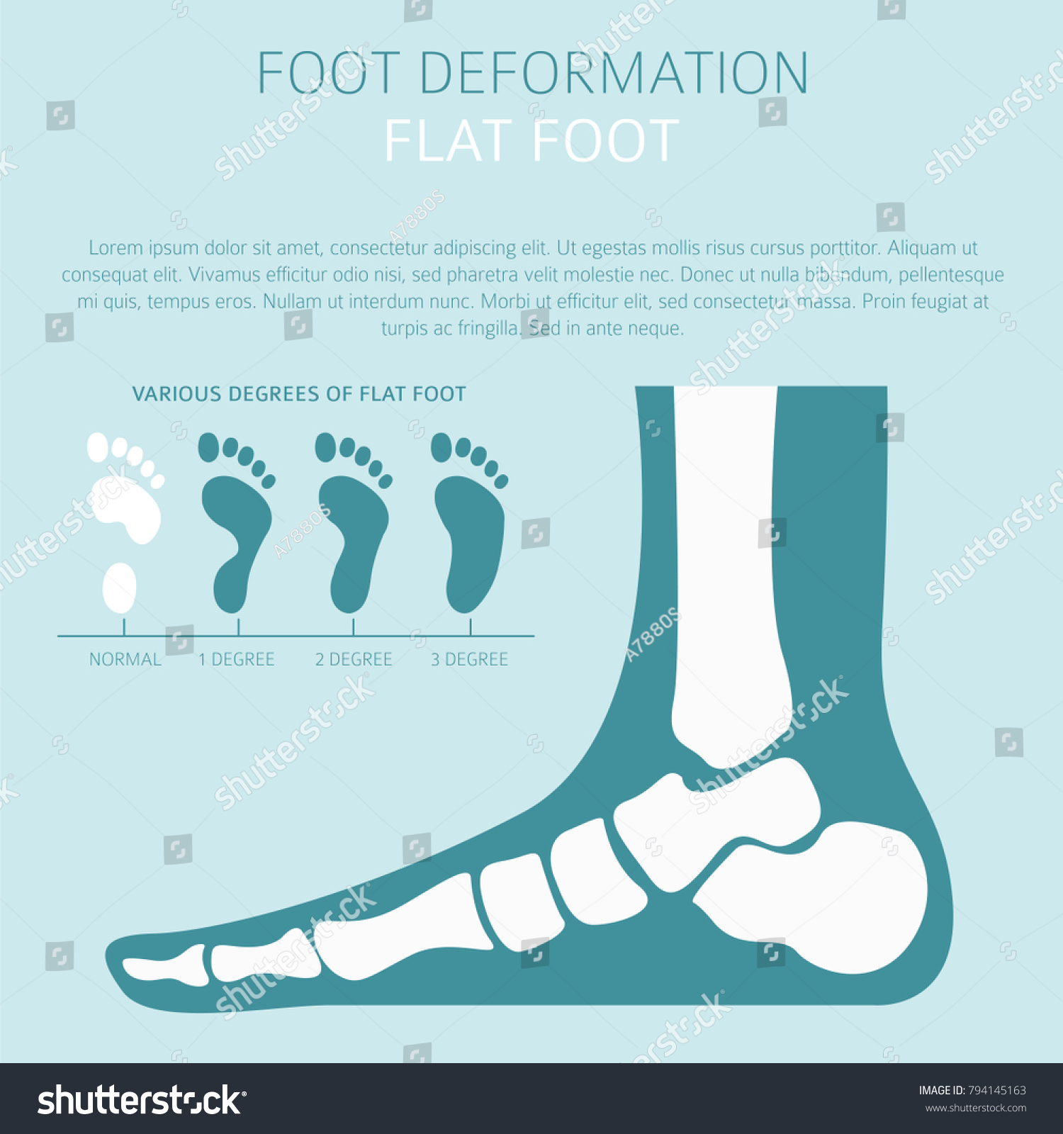 Foot Deformation Medical Desease Infographic Causes Stock Vector ...