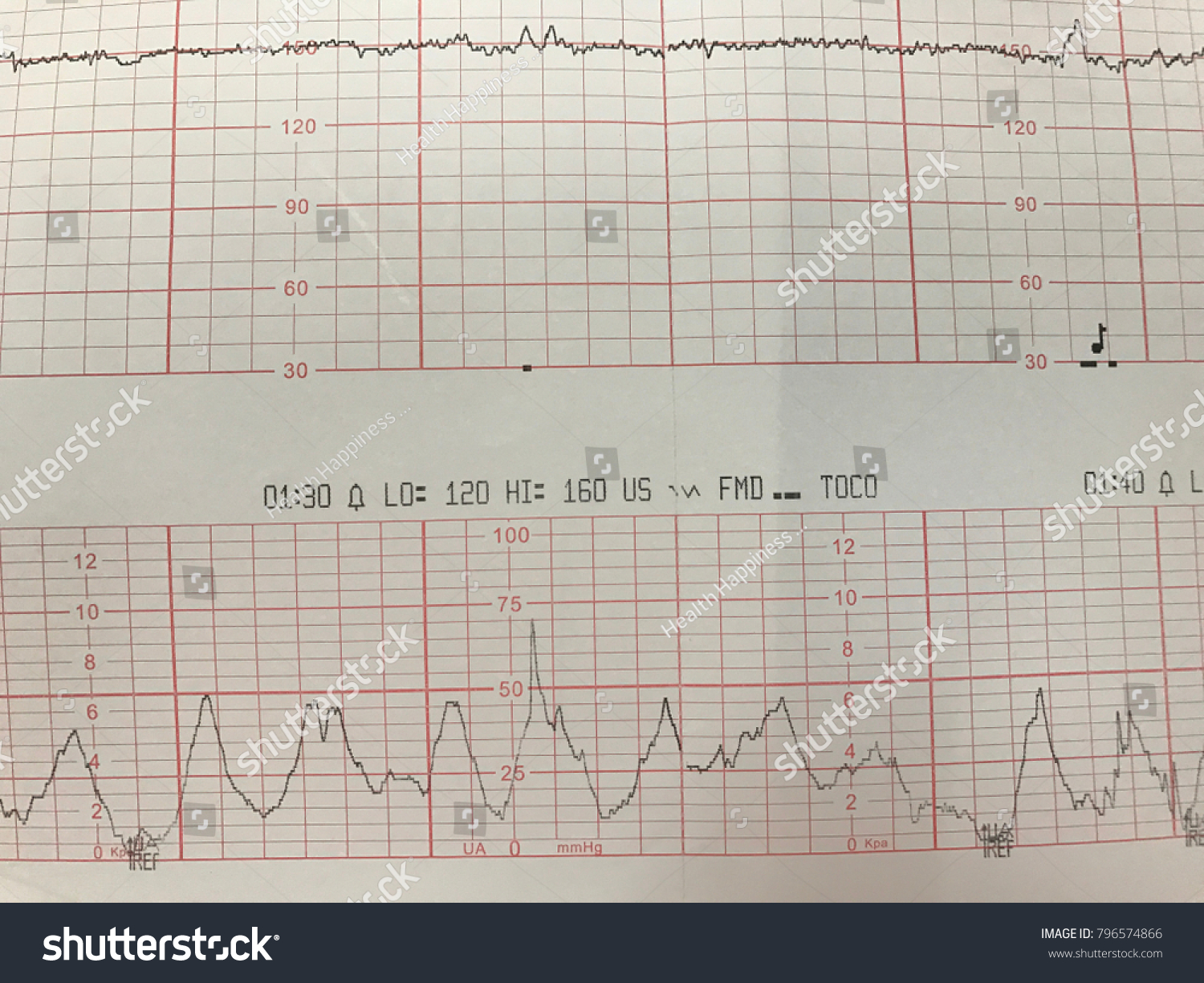 non-stress-test-graph-babys-heart-stock-photo-796574866-shutterstock