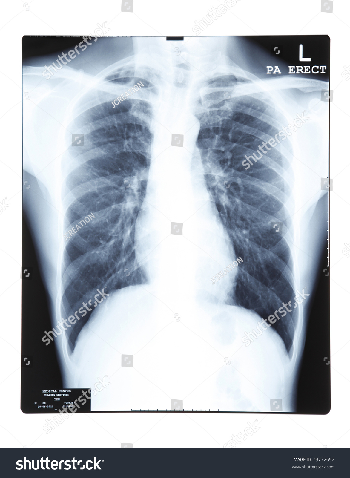 Chest Xray Stock Photo 79772692 | Shutterstock