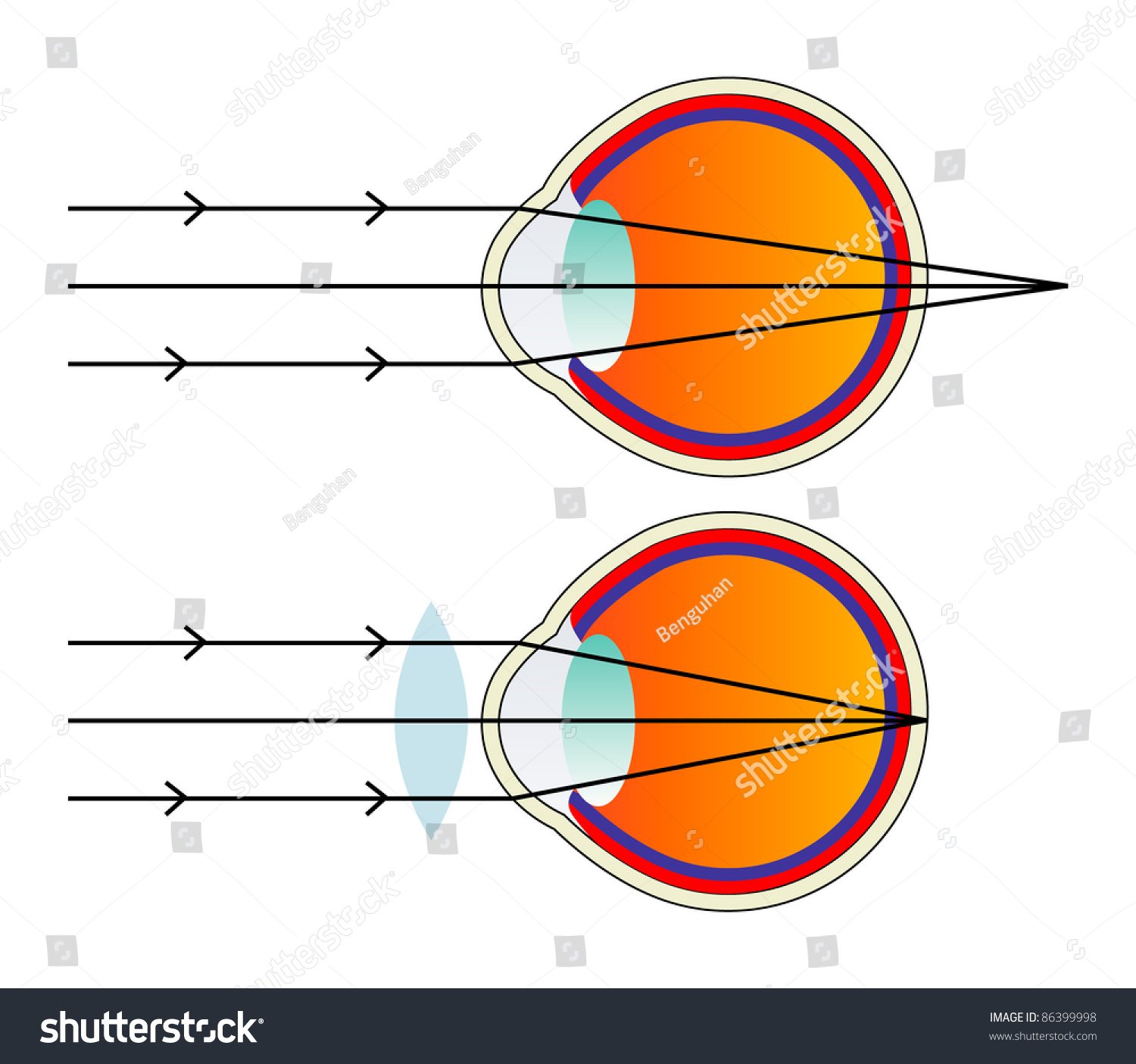 Illustration Hyperopic Eye Comparison Normal Eye Stock Vector (Royalty ...