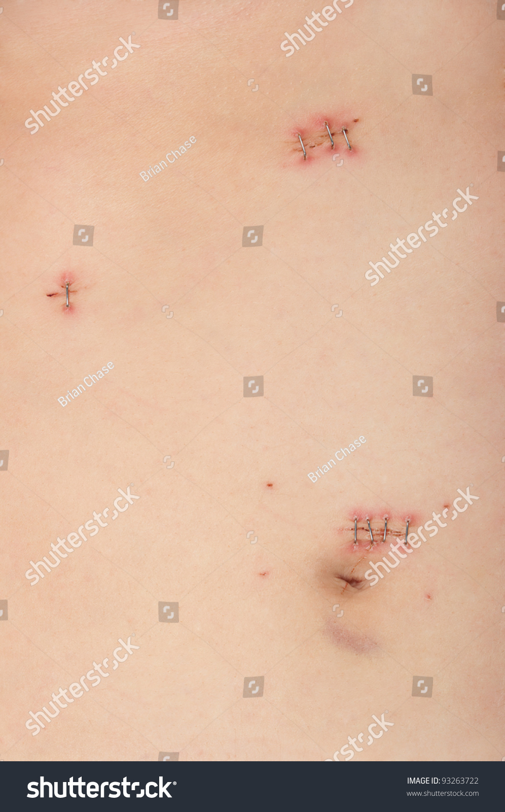 surgery-incisions-laparoscopic-gallbladder-surgery-stock-photo-93263722