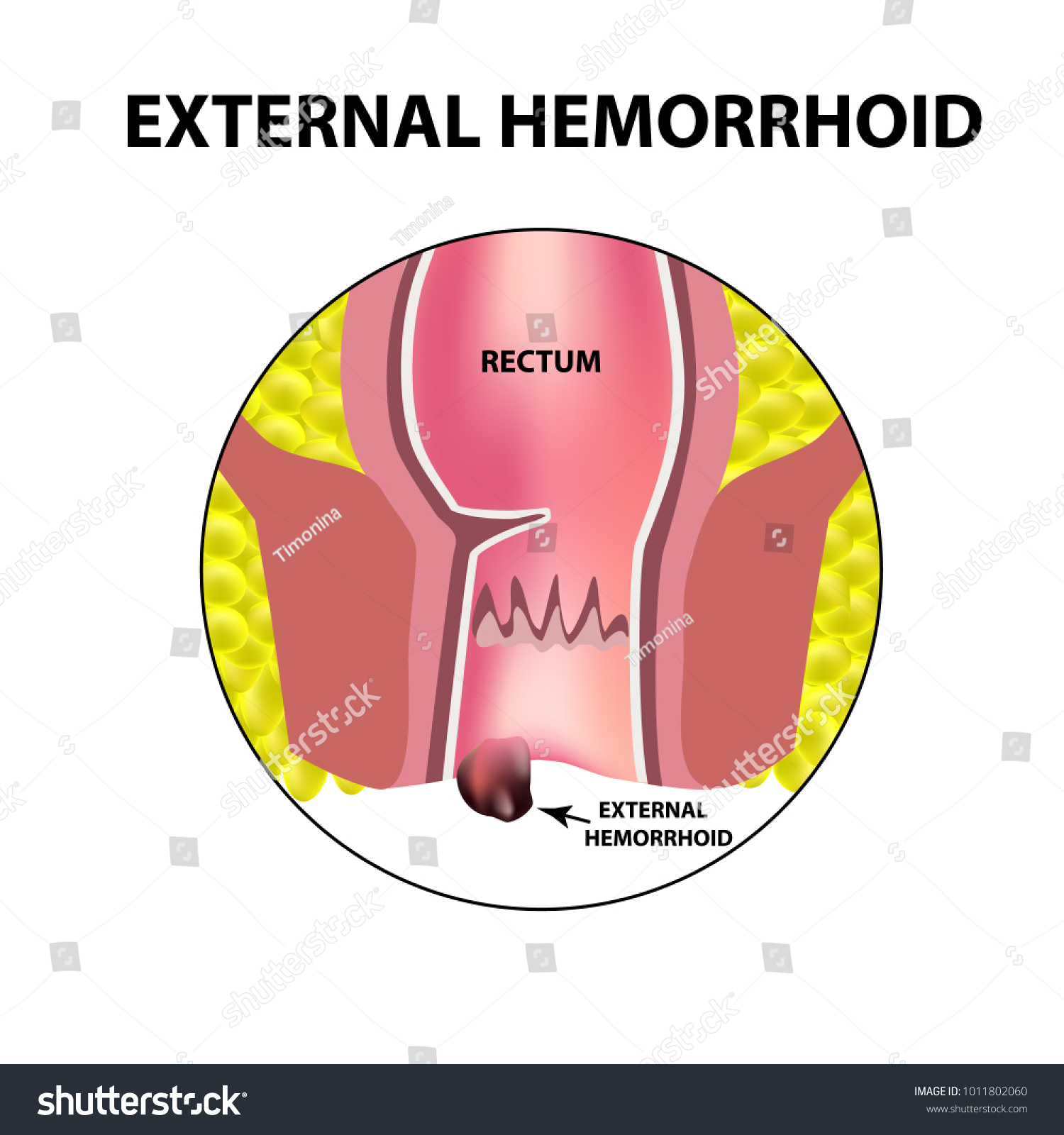 Hemorrhoids external. Rectum structure. - Royalty Free Stock Vector ...