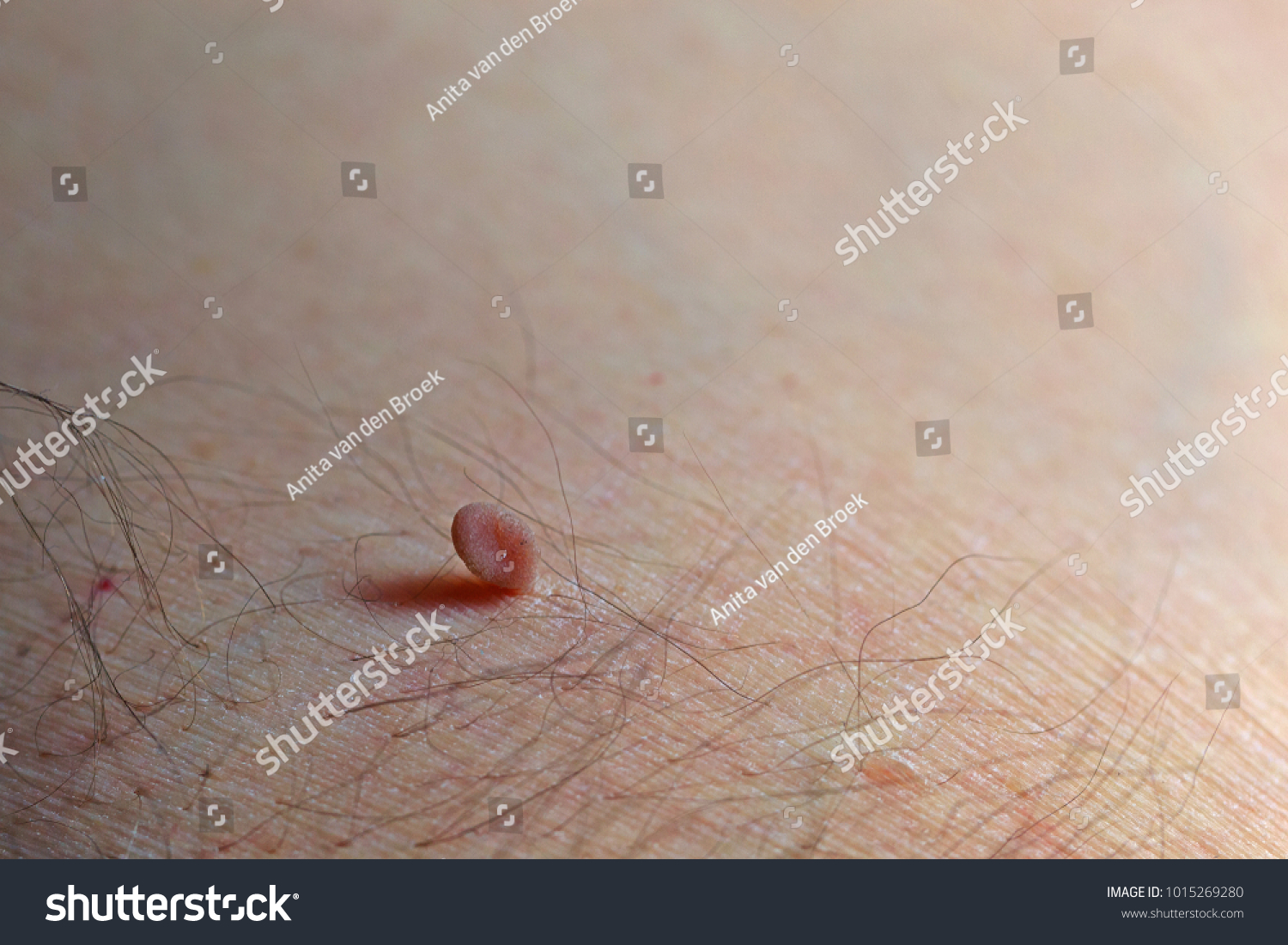 Large brown skin tag attached to the hairy armpit of a man held on by a small section of the tag. Selective focus with space for text. #1015269280