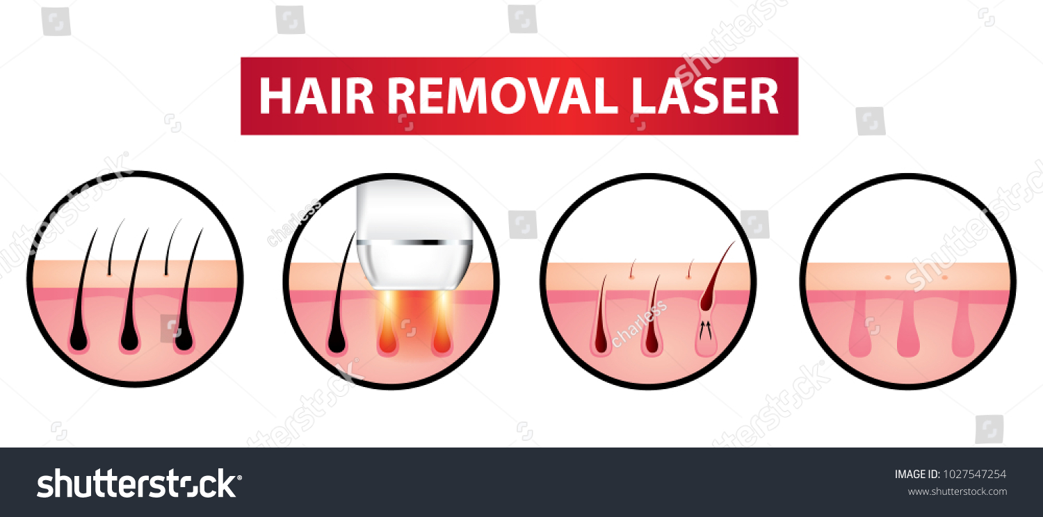 Hair removal laser icon step vector illustration #1027547254