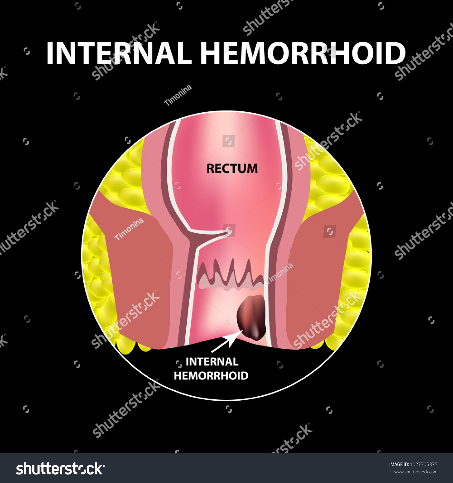 Hemorrhoids Internal Rectum Structure Royalty Free Stock Vector