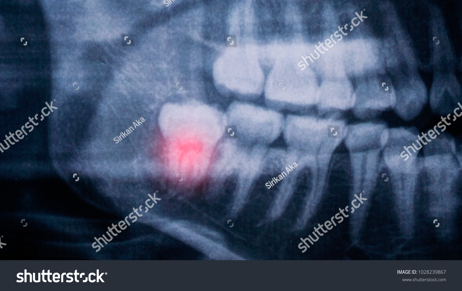 The Radiograph x-ray shows the pain on the lower right  wisdom teeth.  #1028239867
