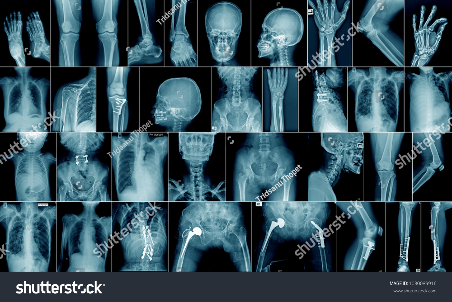 high quality x-ray collection body part and fracture area #1030089916