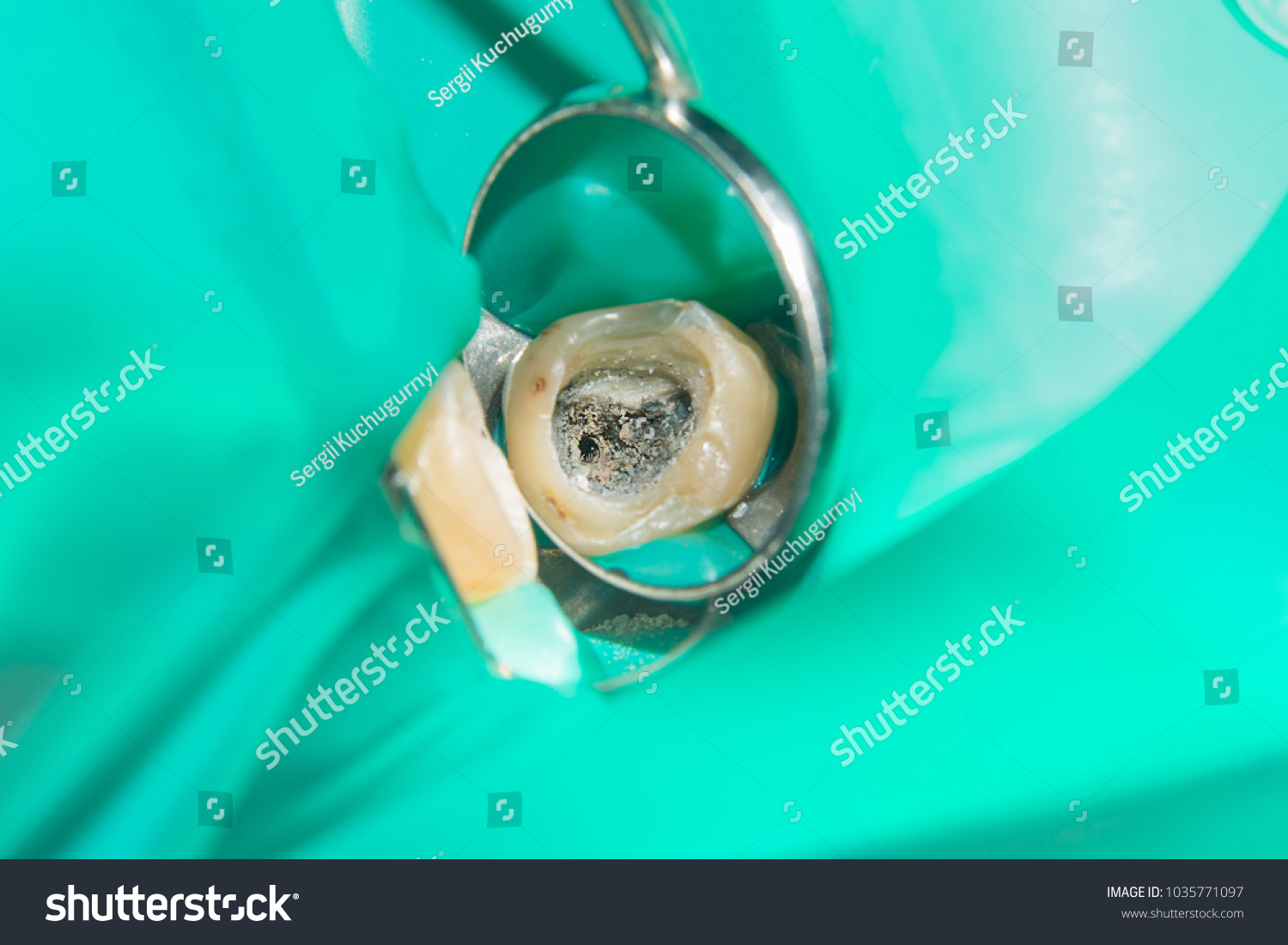 close-up of a human rotten carious tooth at the treatment stage in a dental clinic. The use of rubber dam system with latex scarves and metal clips, production of photopolymeric composite fillings #1035771097