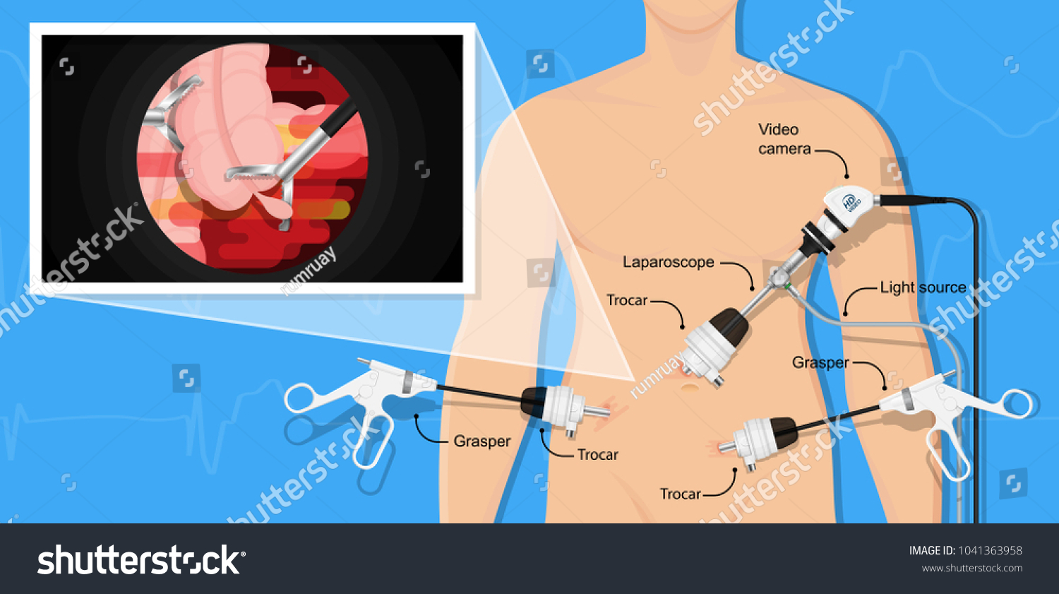 appendectomy medical surgery organ colon tool heal room body doctor pain scars liver cancer tummy tumor mass trocars nurse pelvic video health system display urology monitor endoscopic cholecystitis #1041363958