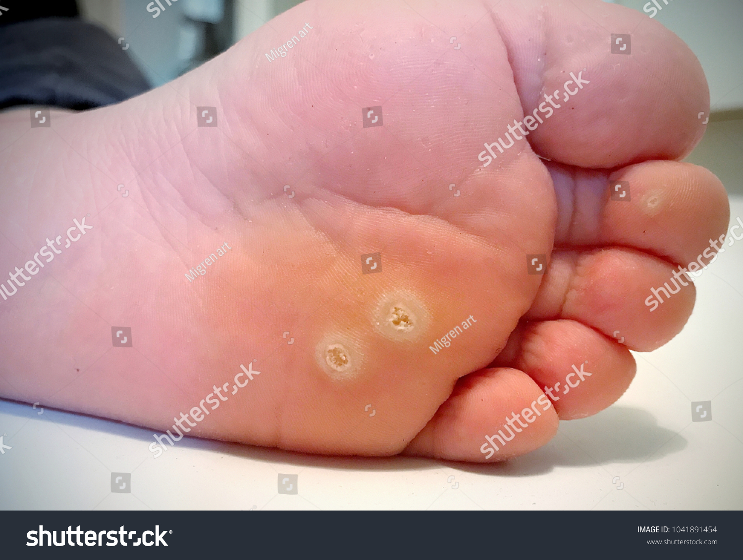 Wart verrucas plantar. Fasciitis Wart on foot. Decease on foot skin. Wart plantar callus foot . Warts plantar verruca foot
 #1041891454