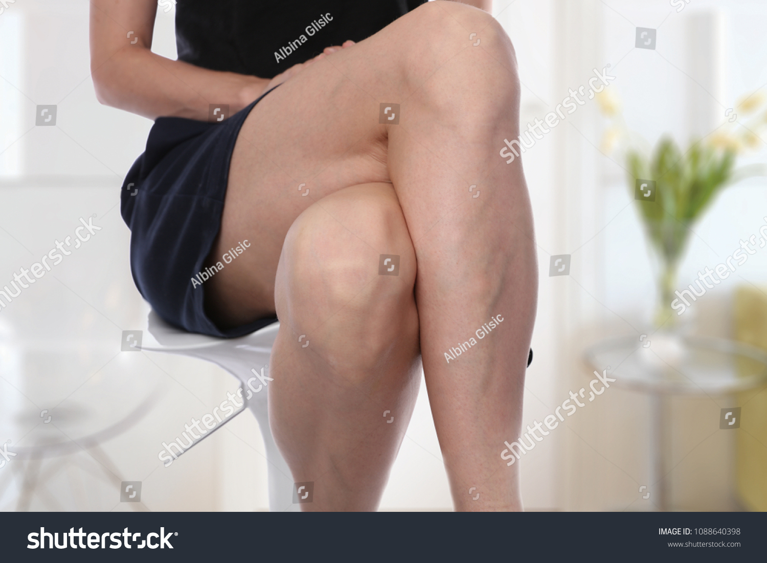 Painful varicose and spider veins on female legs. #1088640398