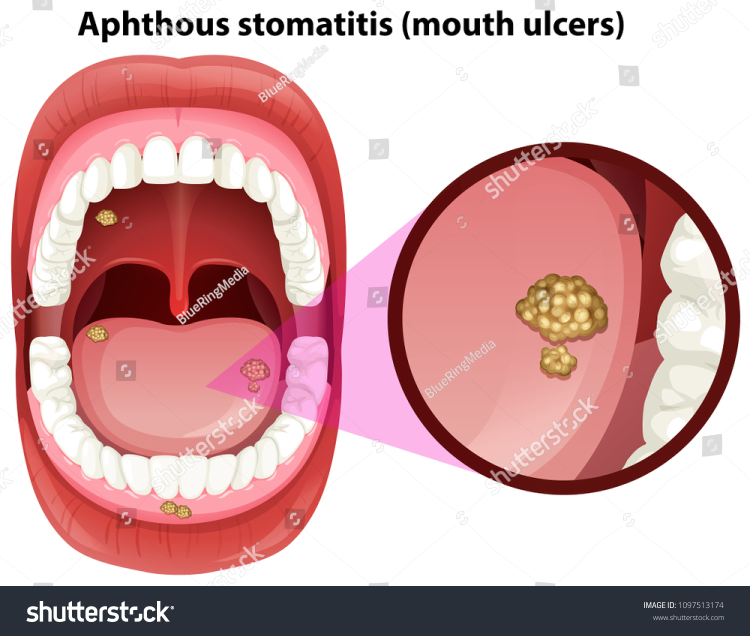 Human Mouth Anatomy of Ulcers illustration - Royalty Free Stock Vector ...