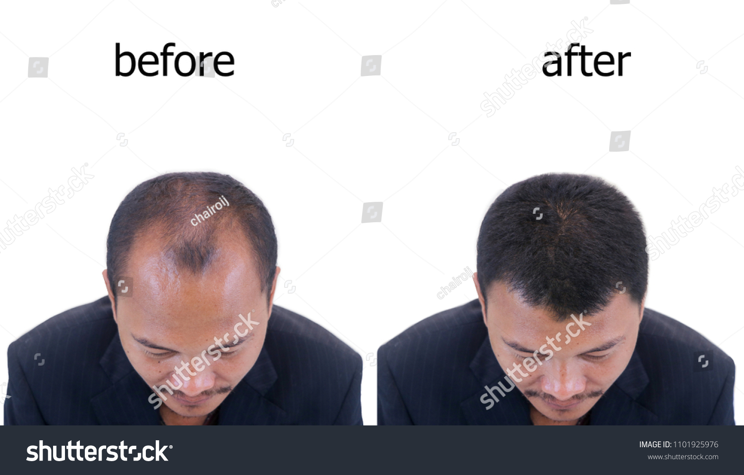 before and after bald head of a man . #1101925976