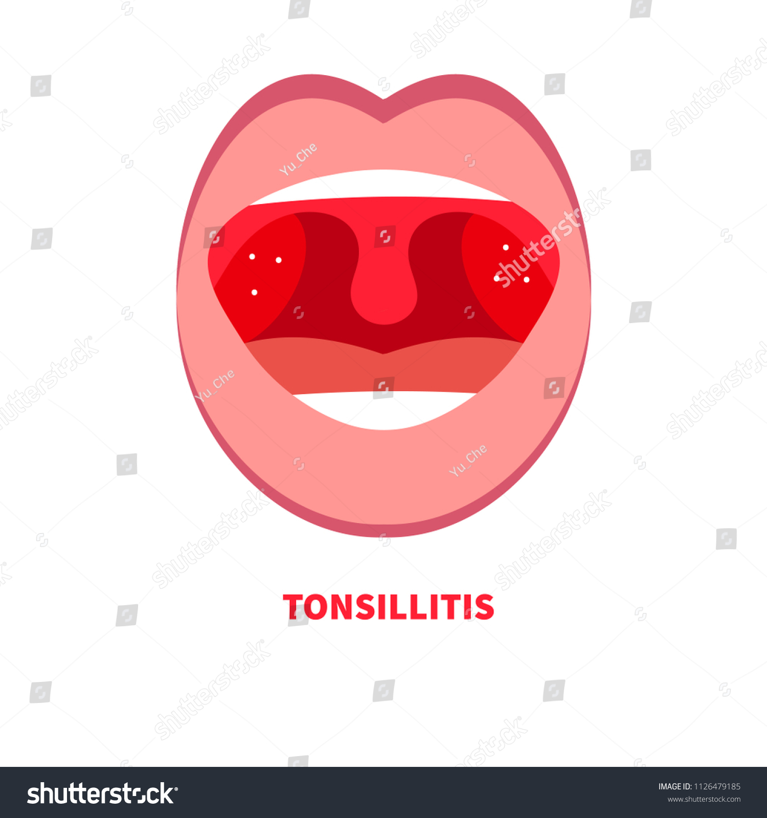 Tonsillitis, Angina, Sore Throat, Cold Throat, - Royalty Free Stock 