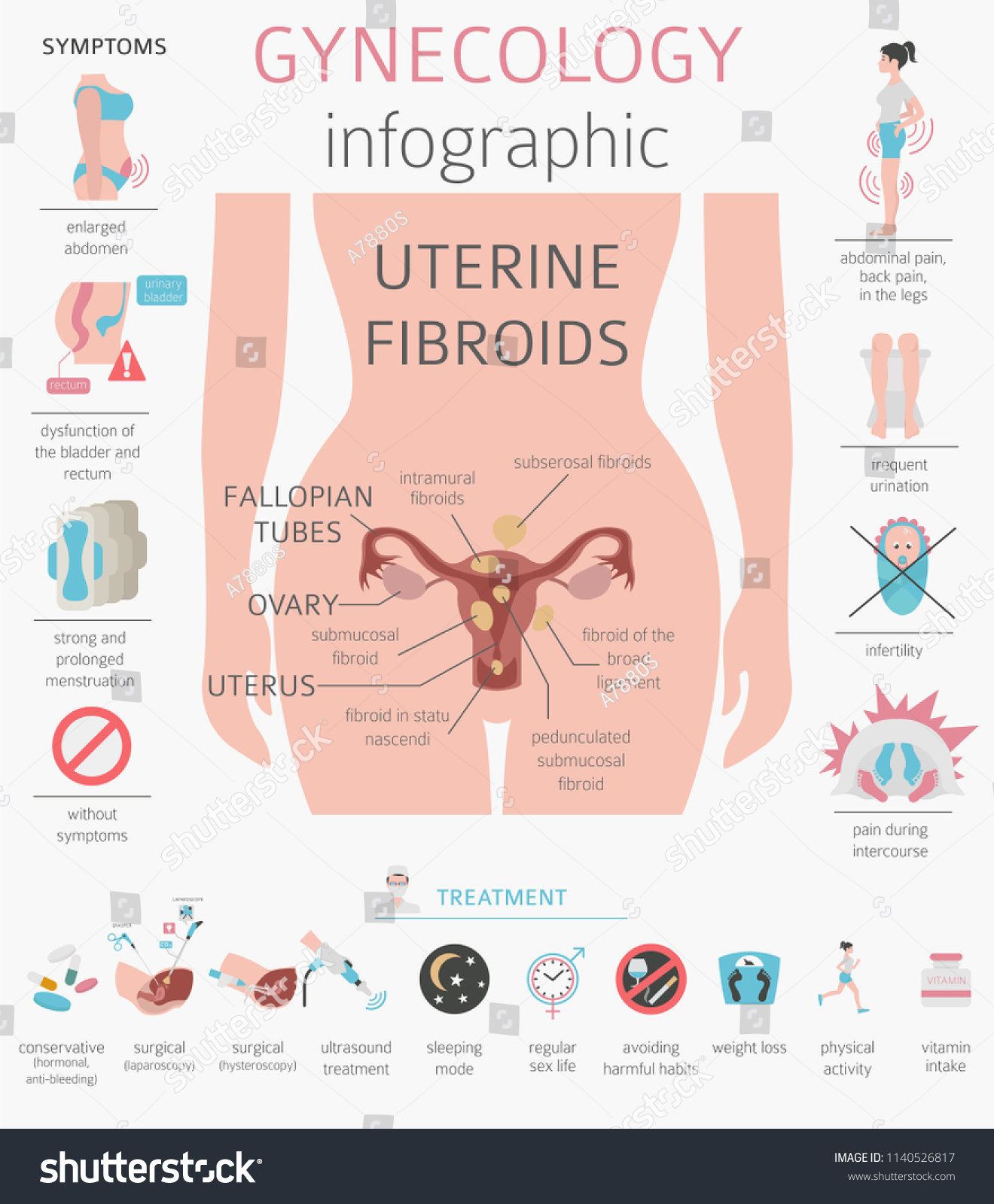 Uterine Fibroids Ginecological Medical Desease Royalty Free Stock