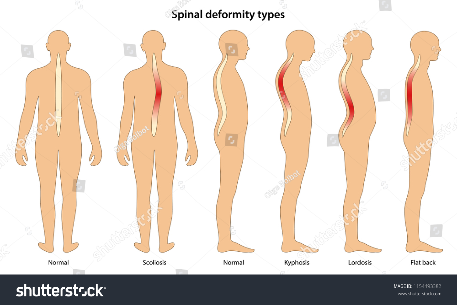 Spinal deformity types. Anterior view and - Royalty Free Stock Vector ...