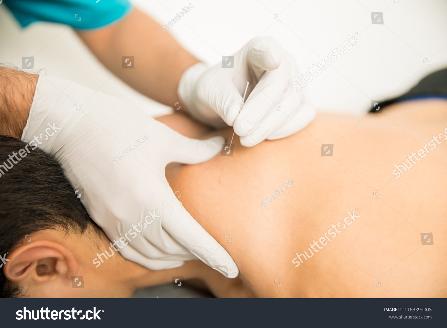Closeup of shirtless man receiving dry needling therapy from doctor in clinic #1163399008