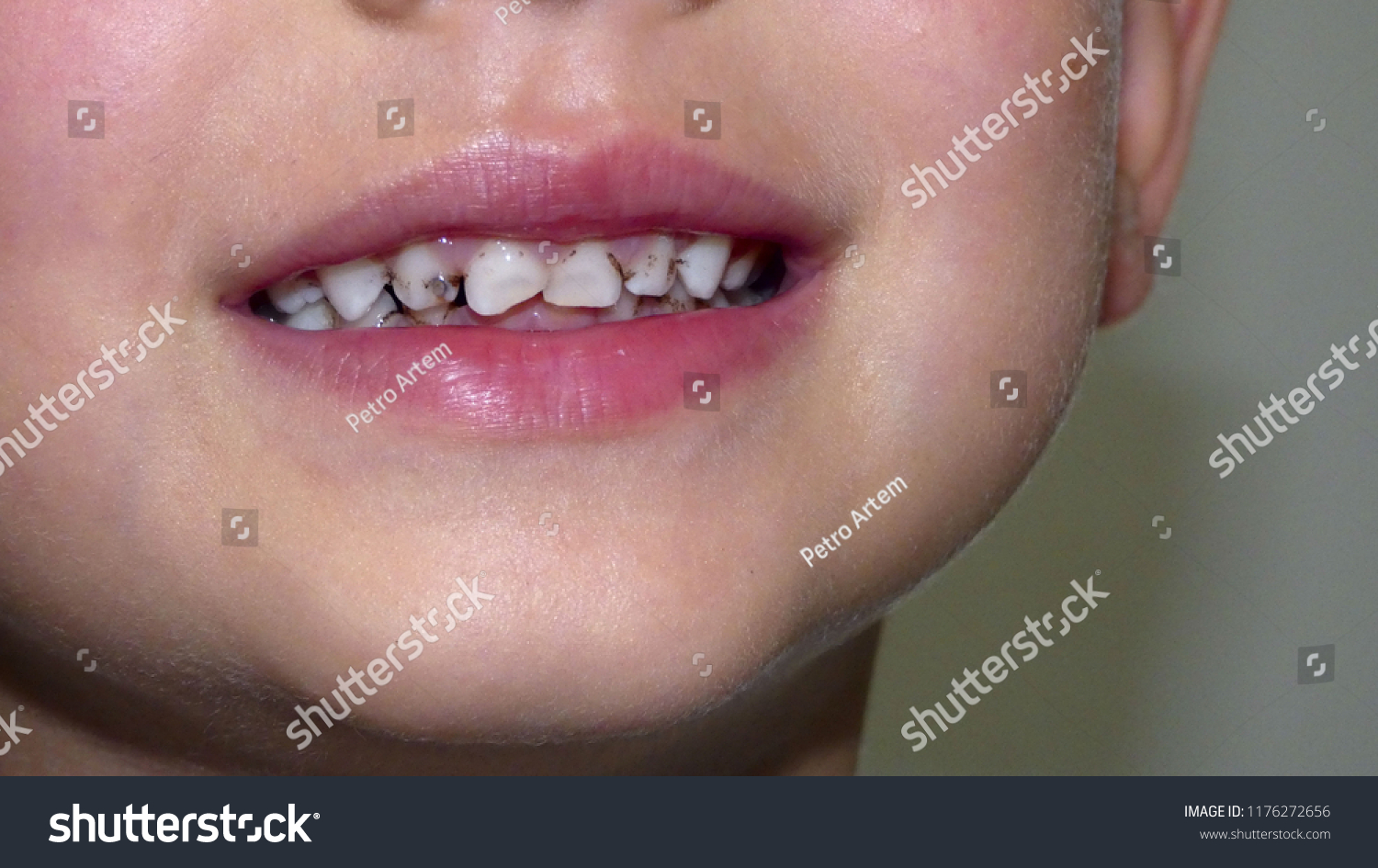 child caries. bad teeth #1176272656