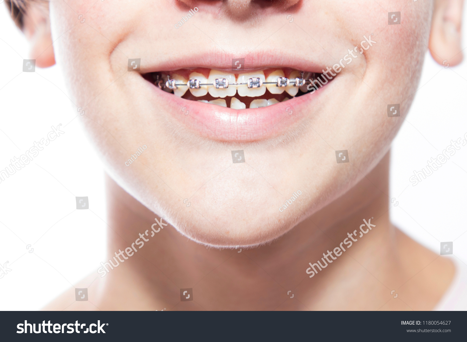 close-up of mouth with dental corrector or braces #1180054627