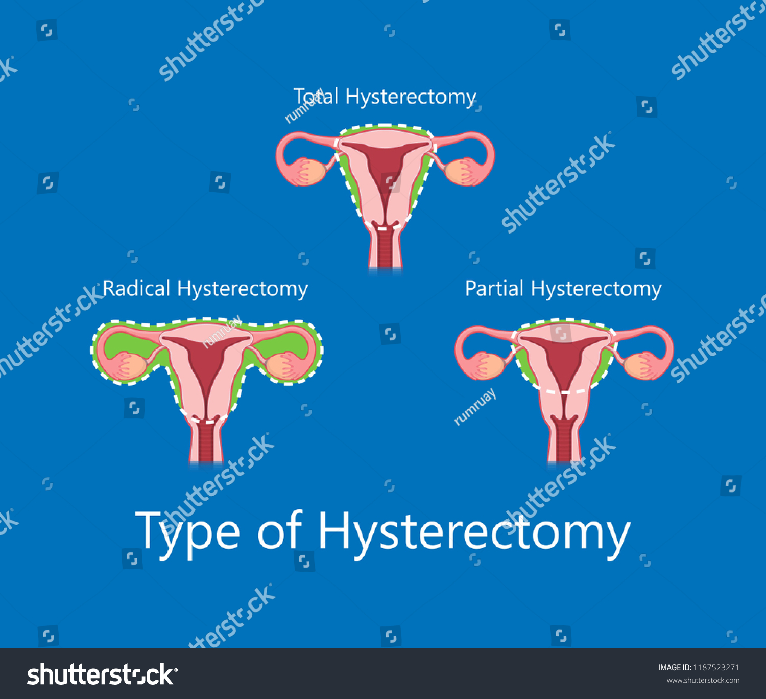 Laparoscopic Hysterectomy Medical Surgical Treat Royalty Free Stock Vector 1187523271 8174