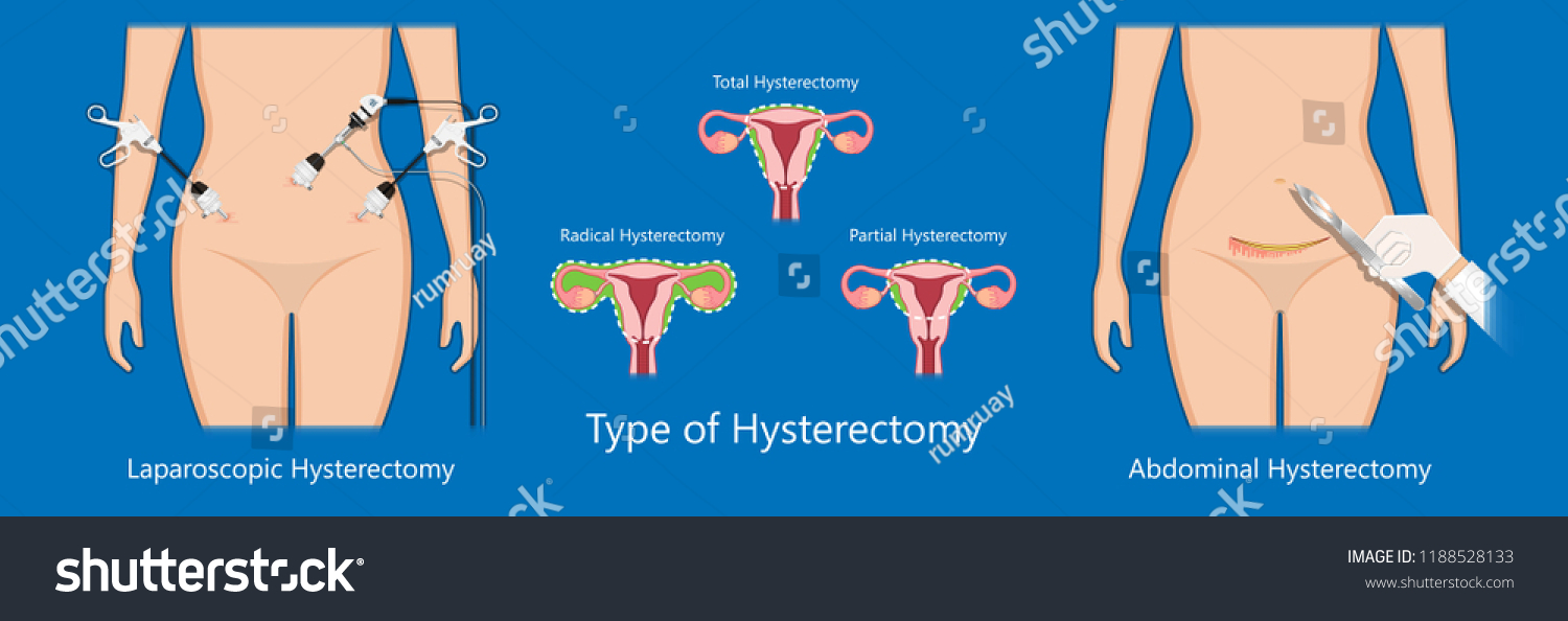 Laparoscopic Hysterectomy Medical Surgical Treat Royalty Free Stock Vector 1188528133 6132