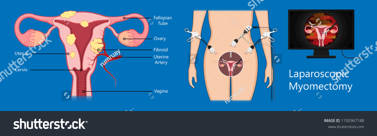Laparoscopic Hysterectomy Medical Surgical Treat Royalty Free Stock Vector 1192967188 7922