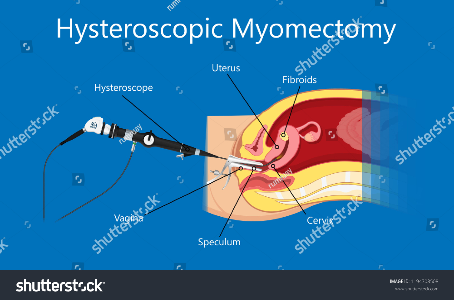 Laparoscopic Hysterectomy Medical Surgical Treat Royalty Free Stock Vector 1194708508 1195