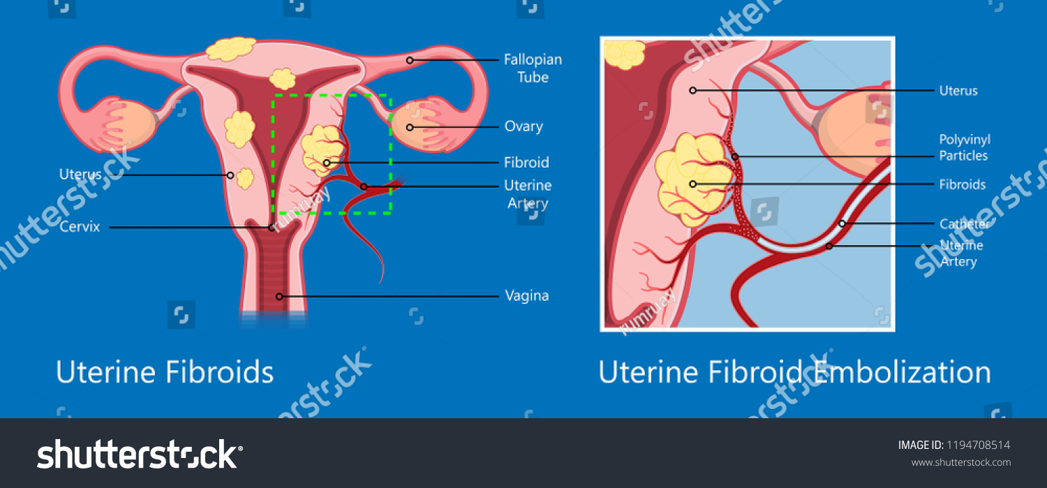 Laparoscopic Hysterectomy Medical Surgical Treat Royalty Free Stock Vector 1194708514 7532