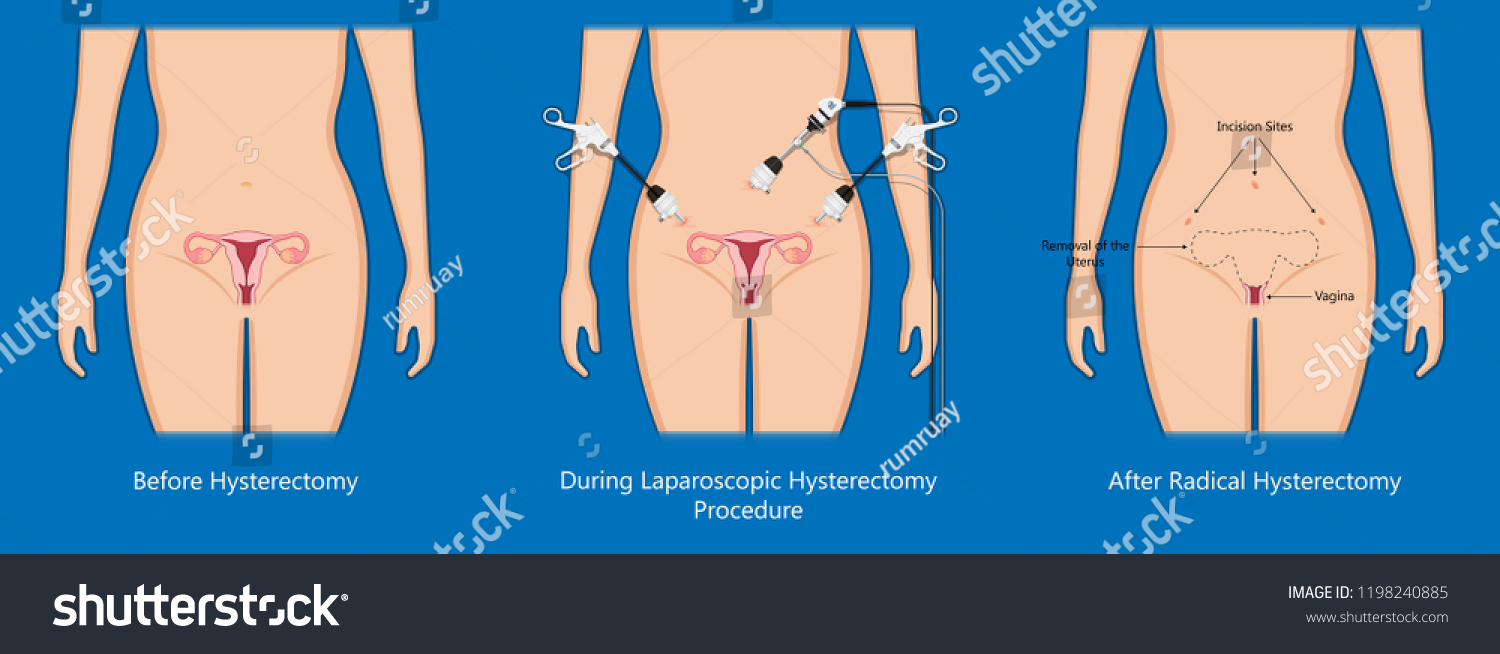 Laparoscopic Hysterectomy Medical Surgical Treat Royalty Free Stock Vector 1198240885