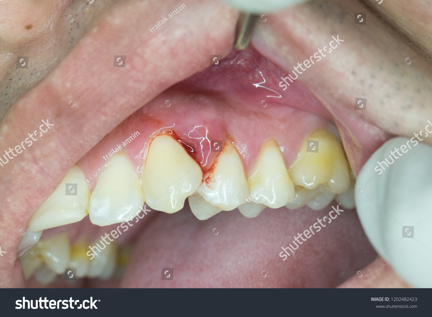 gingival abscess from periodontal problem - Royalty Free Stock Photo ...