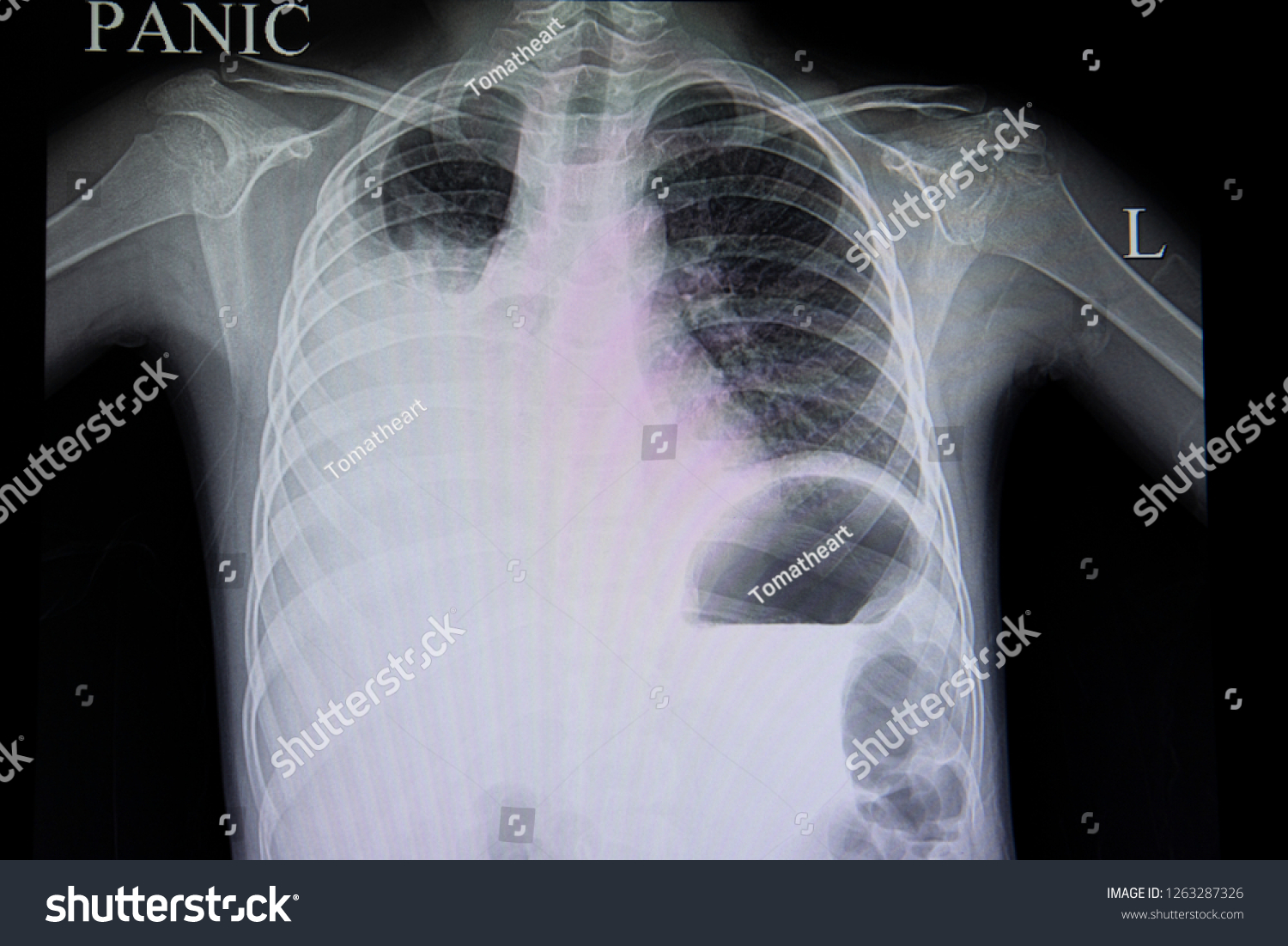 A chest film of a patient with dengue - Royalty Free Stock Photo ...