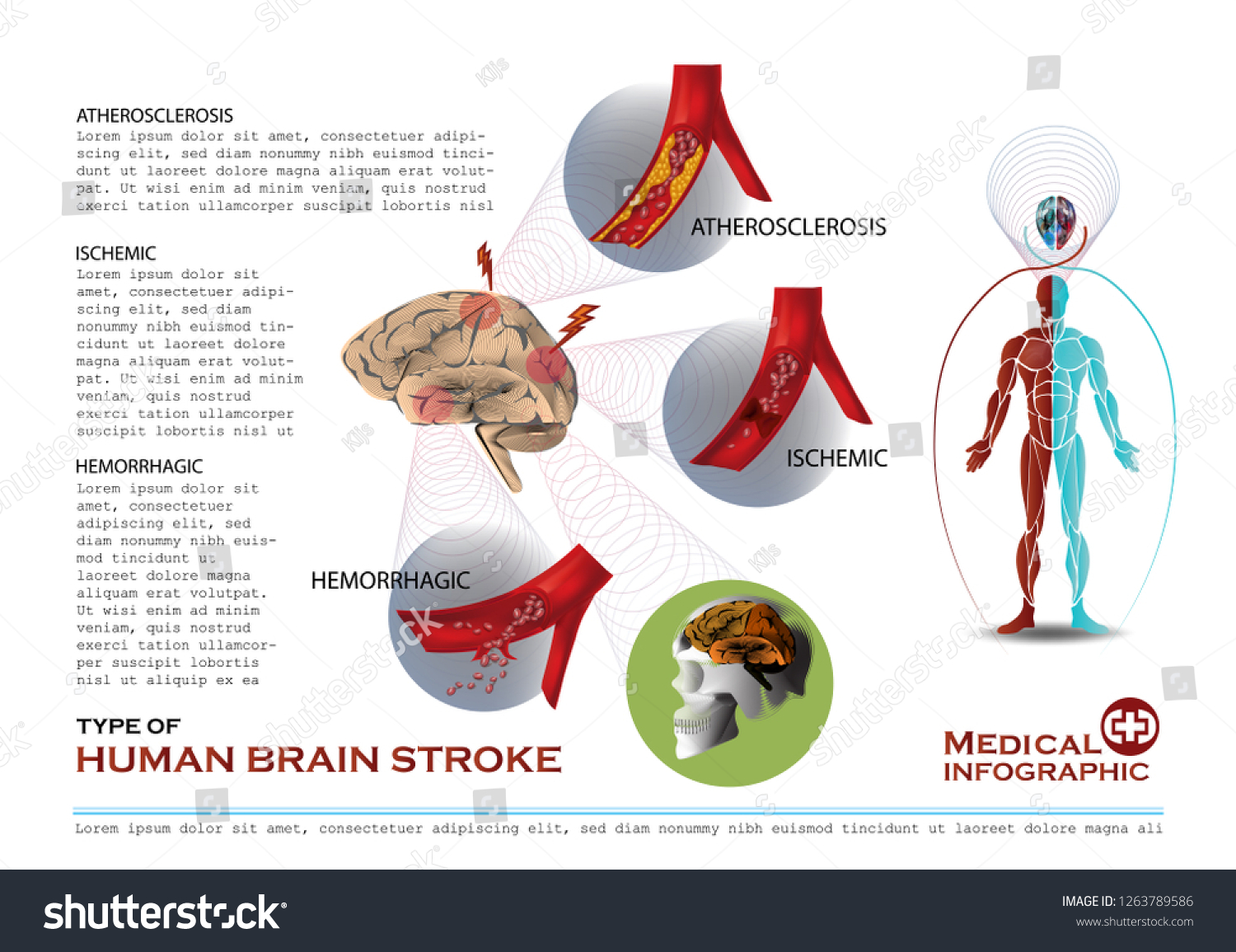 Type Of Human Brain Stroke Medical Infographic - Royalty Free Stock ...