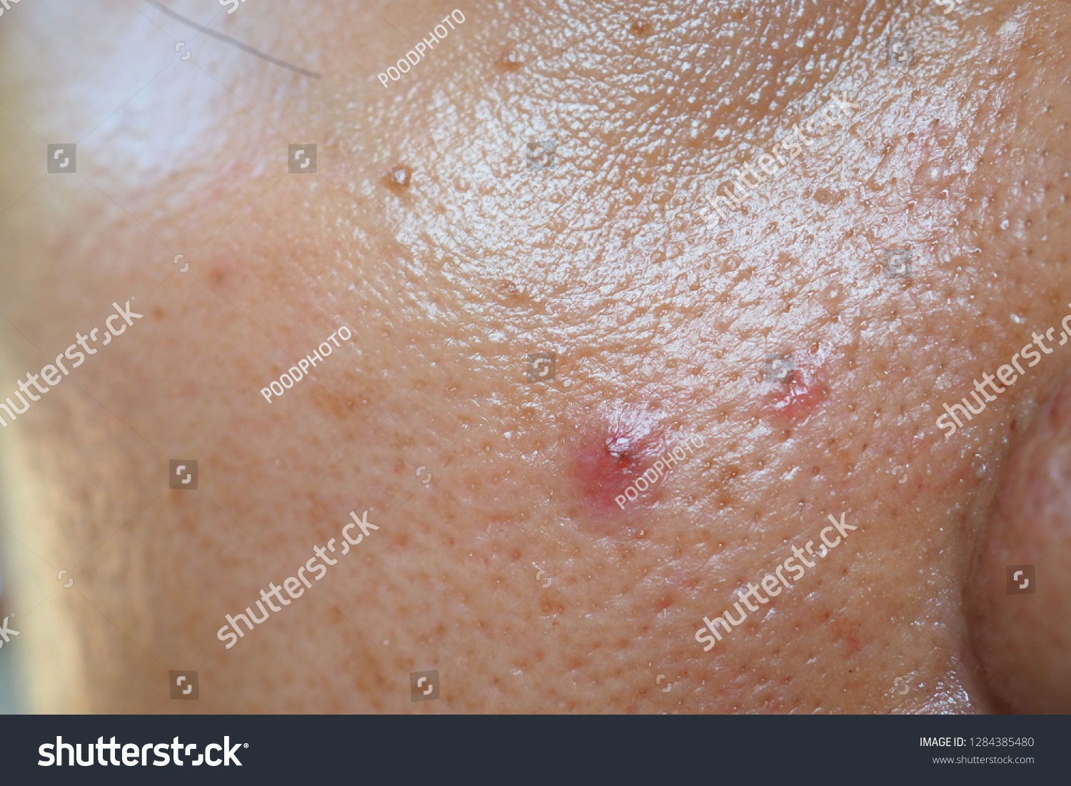 Pimple and acne on face skin and nose, zoom macro. Oily pore skin. #1284385480