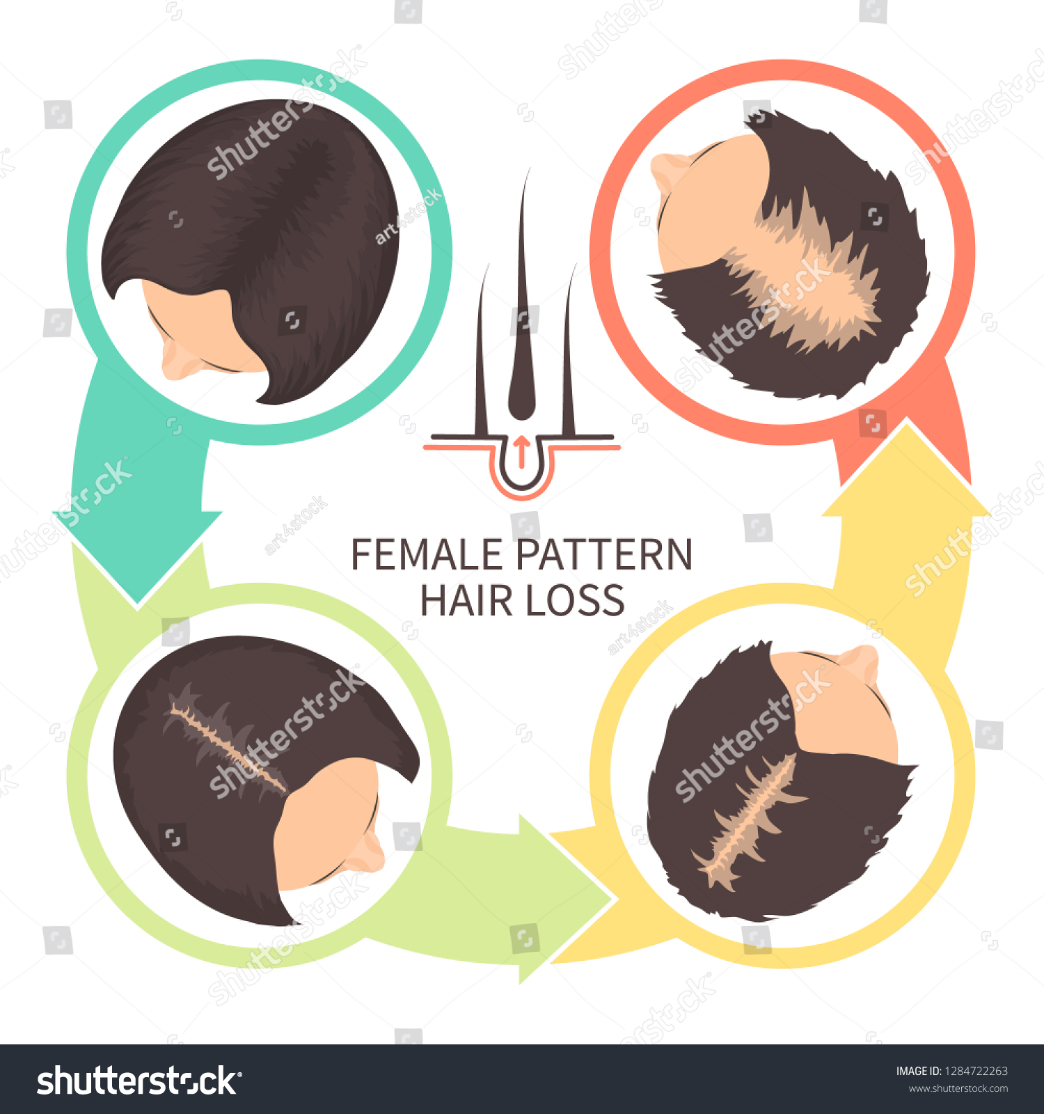 Female Pattern Hair Loss Set Stages Of Baldness Royalty Free Stock