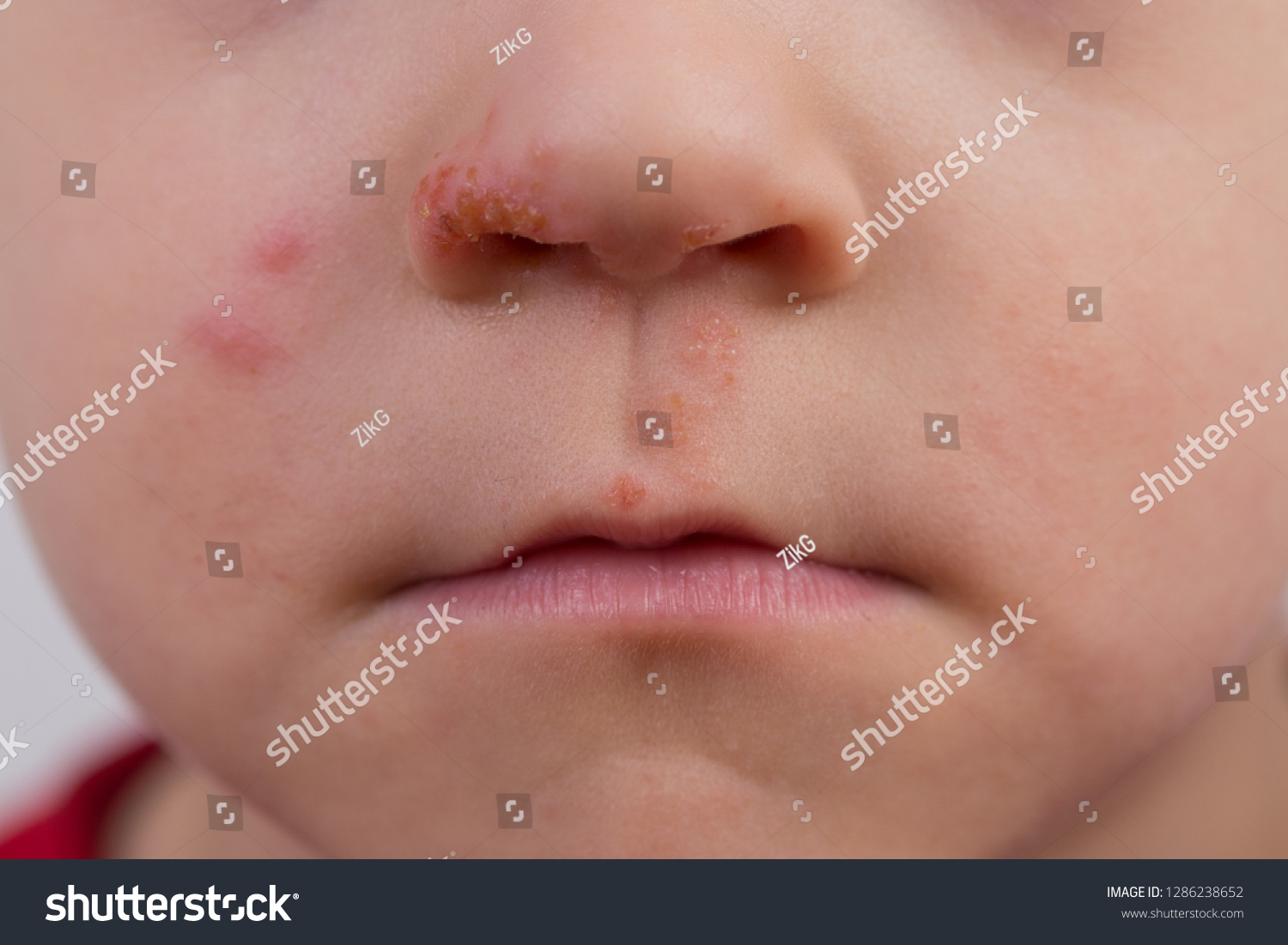 Close up of herpes breakout on boys face around nose and upper lip.  #1286238652