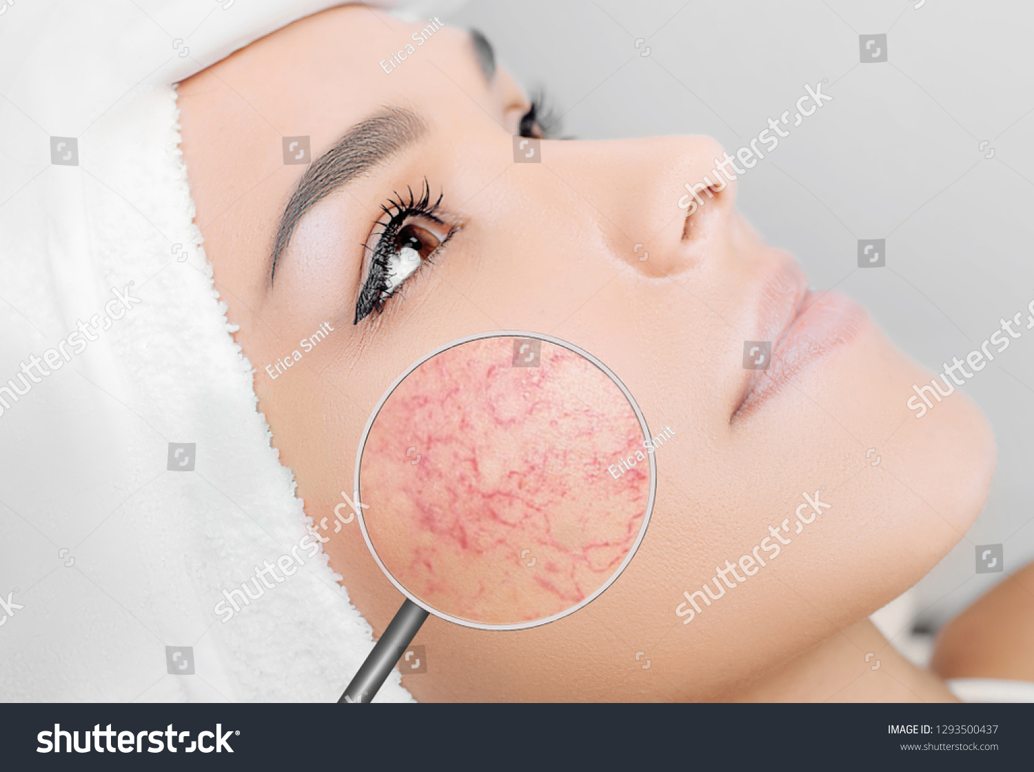 magnifying glass showing couperose on face skin. Woman showing problems couperose-prone sensitive skin #1293500437