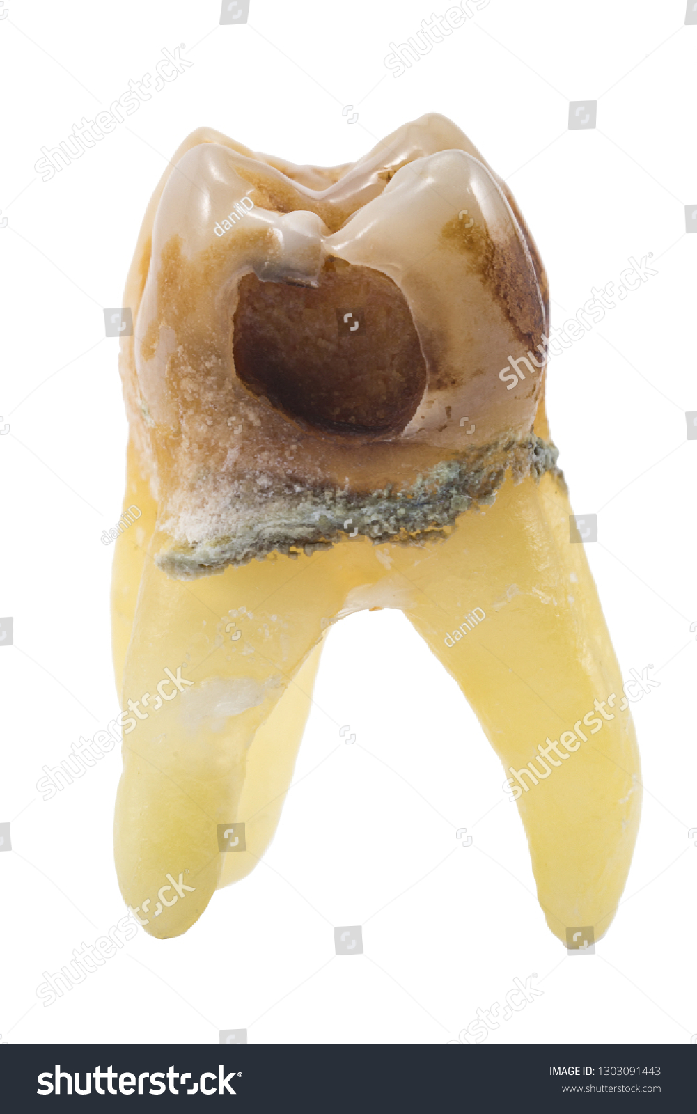 extracted caries tooth isolated on white background close-up macro, lower molar #1303091443