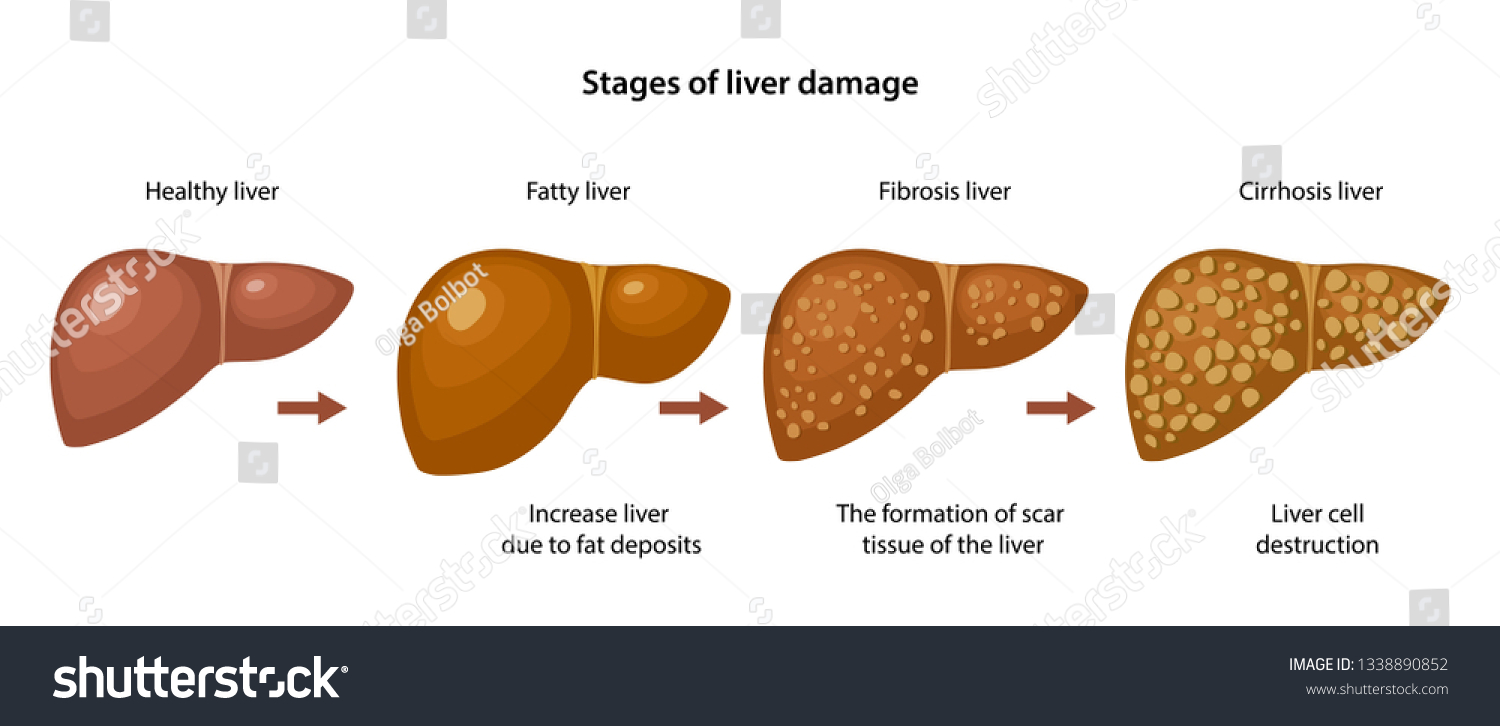 Stages Of Liver Damage With Description Royalty Free Stock Vector 1338890852