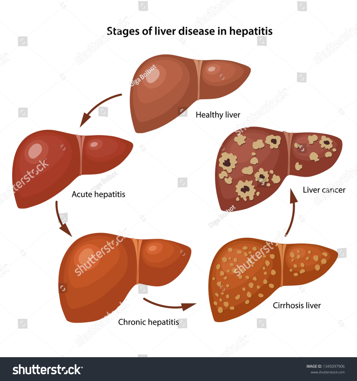 Stages Of Liver Disease In Hepatitis With Royalty Free Stock Vector 1345097906