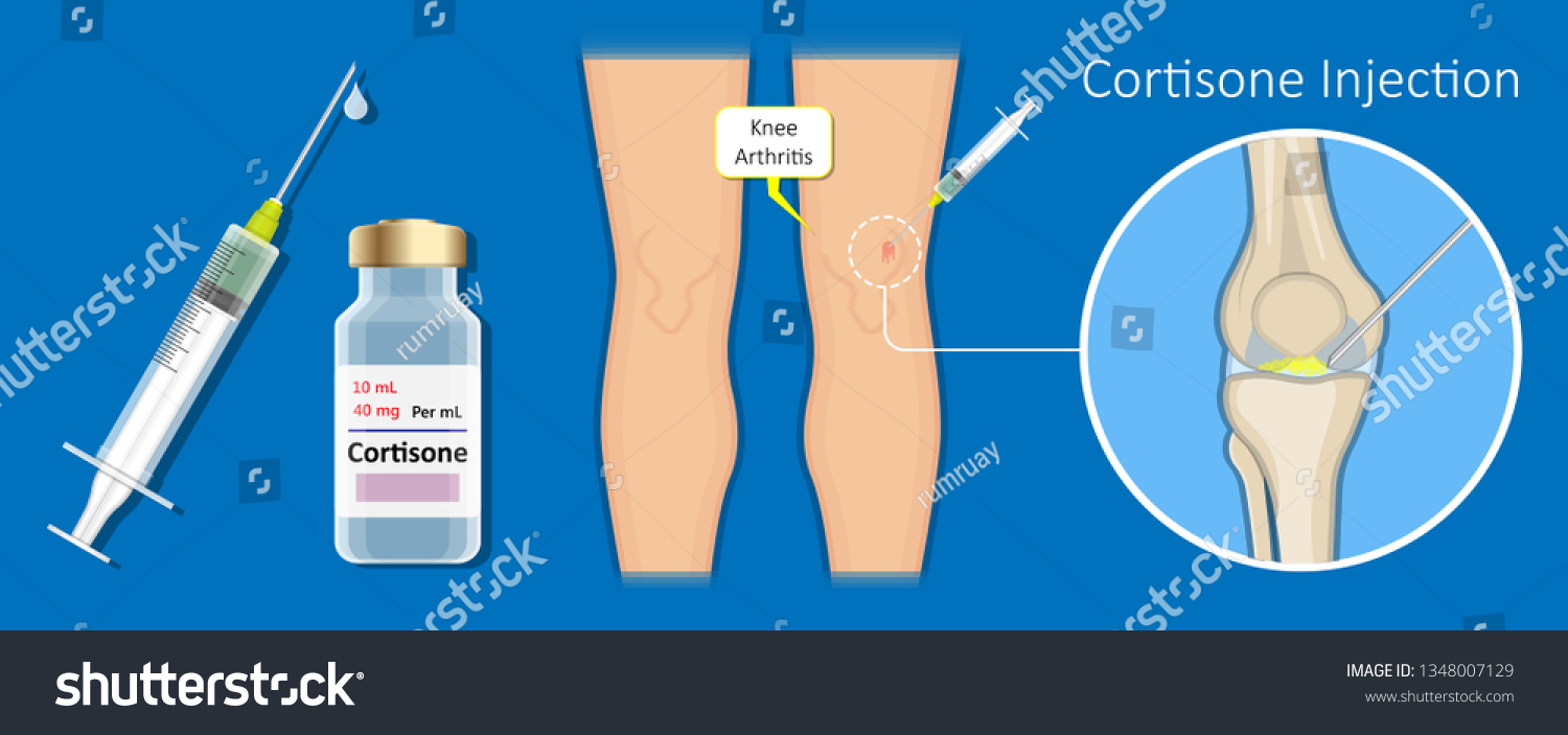 Cortisone Injection Back Price at Richard Parker blog