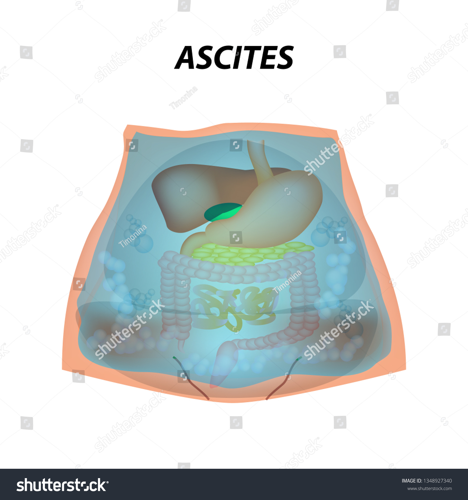 Ascites Free Fluid In The Abdominal Cavity Royalty Free Stock Vector