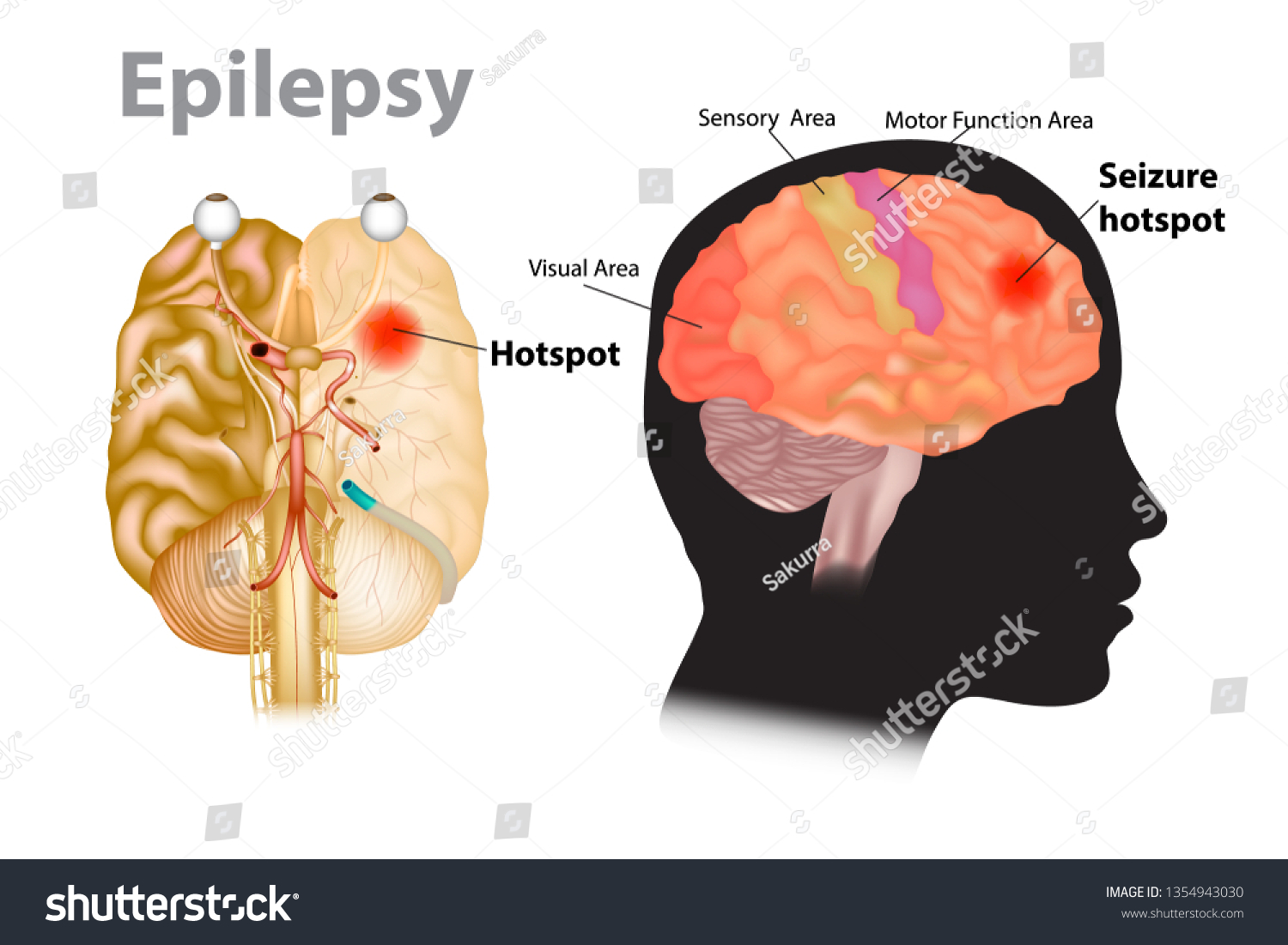 Seizures Epilepsy Seizure Hotspot Medical Royalty Free Stock Vector 1354943030 5270