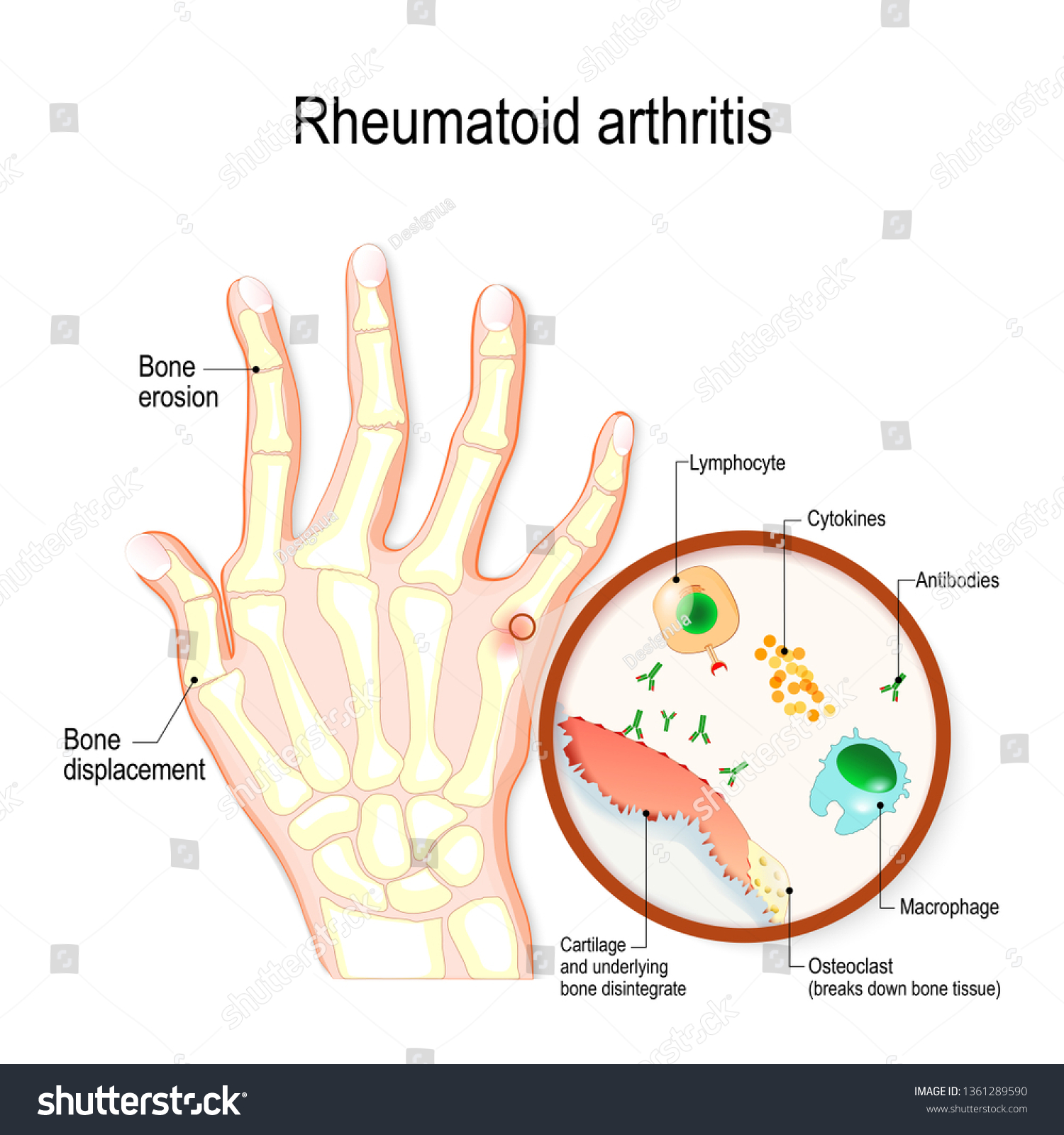 Rheumatoid Arthritis Ra Is An Auto Immune Royalty Free Stock Photo