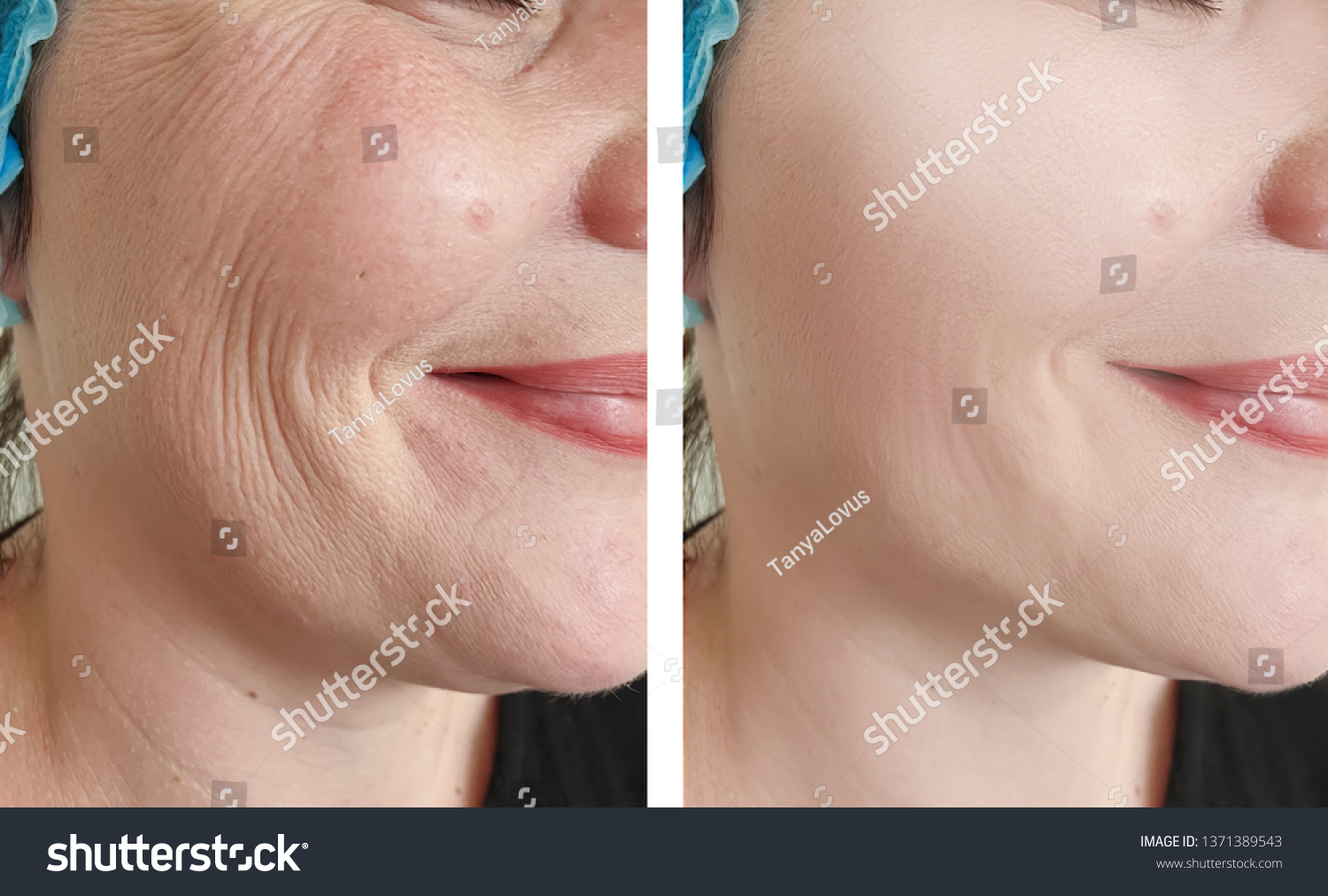 woman wrinkles   after procedures #1371389543
