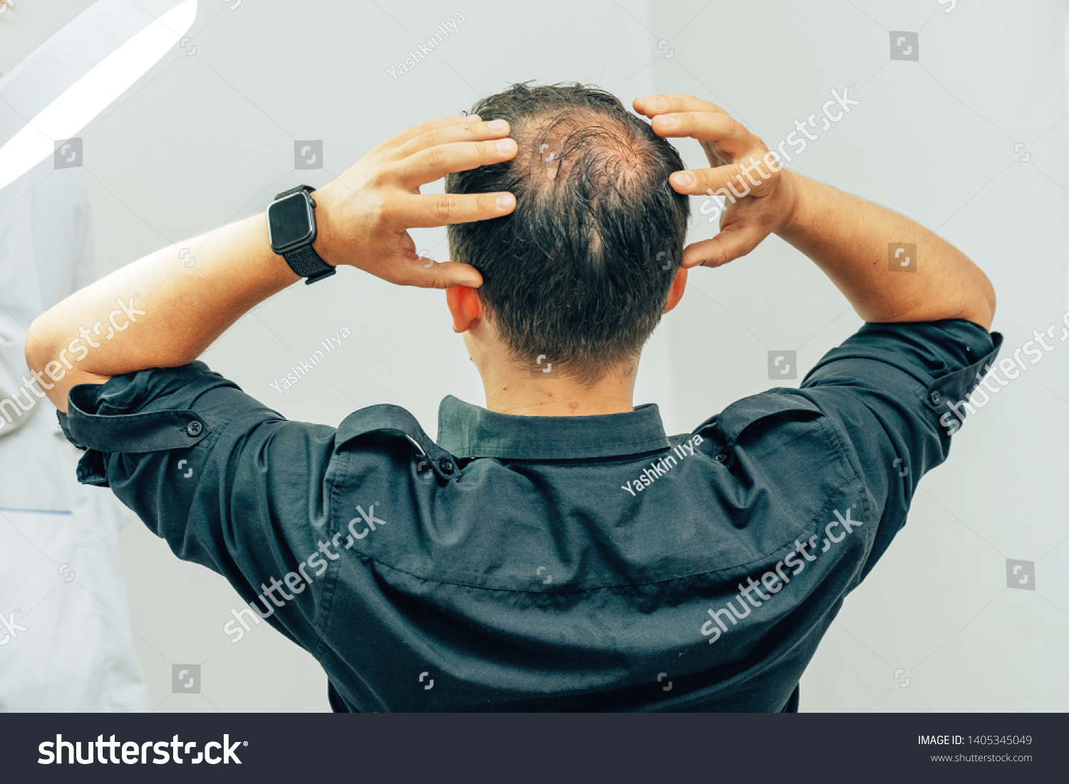A young man with a bald spot in the office of a trichologist cosmetologist. Bald on a man's head. Male pattern baldness. Fighting hair loss in men. #1405345049