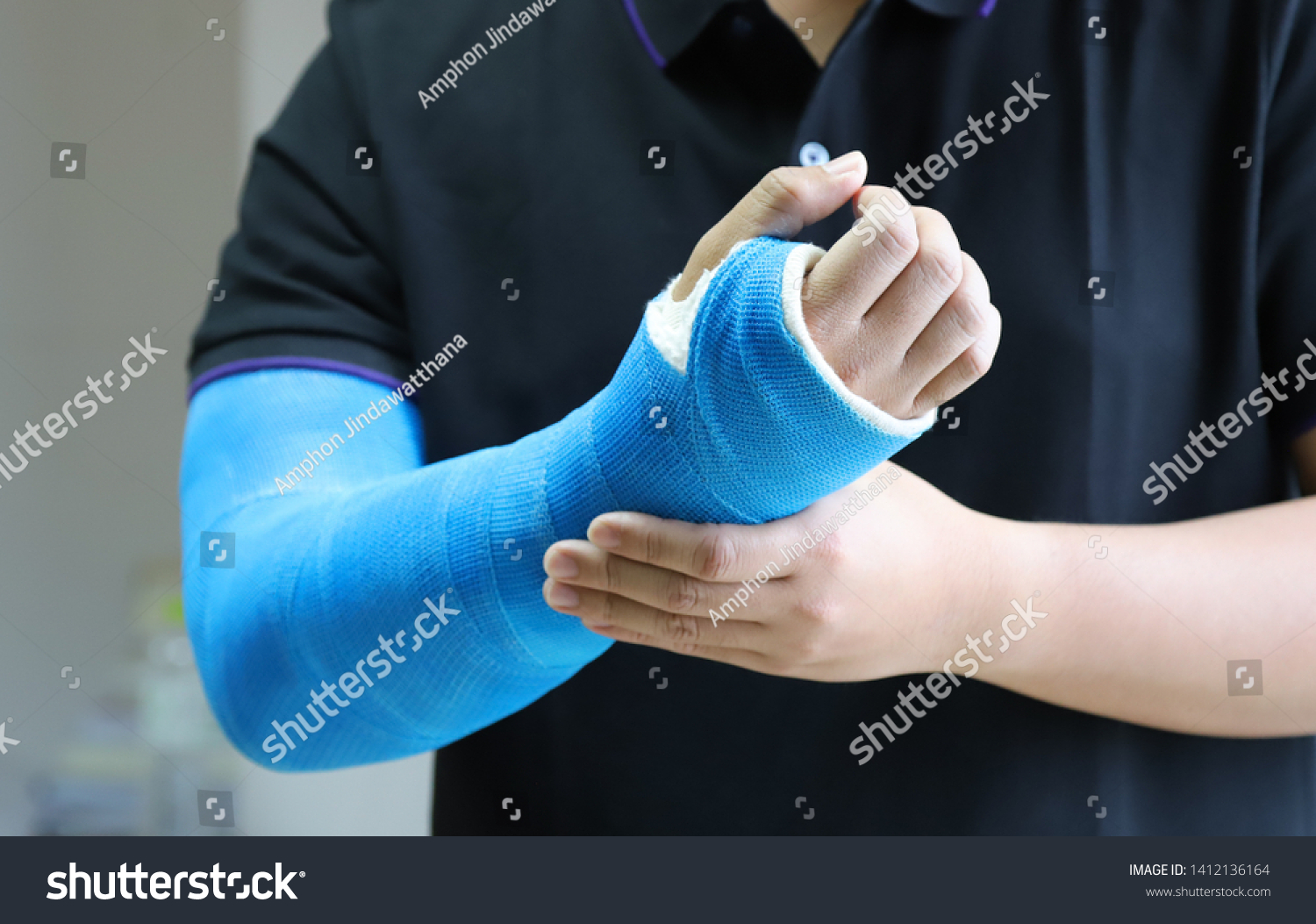 Closeup of asian man's arm with long arm plaster, fiberglass cast therapy cover by blue elastic bandage after sport accident. Appropriate treatment in western medicine. #1412136164