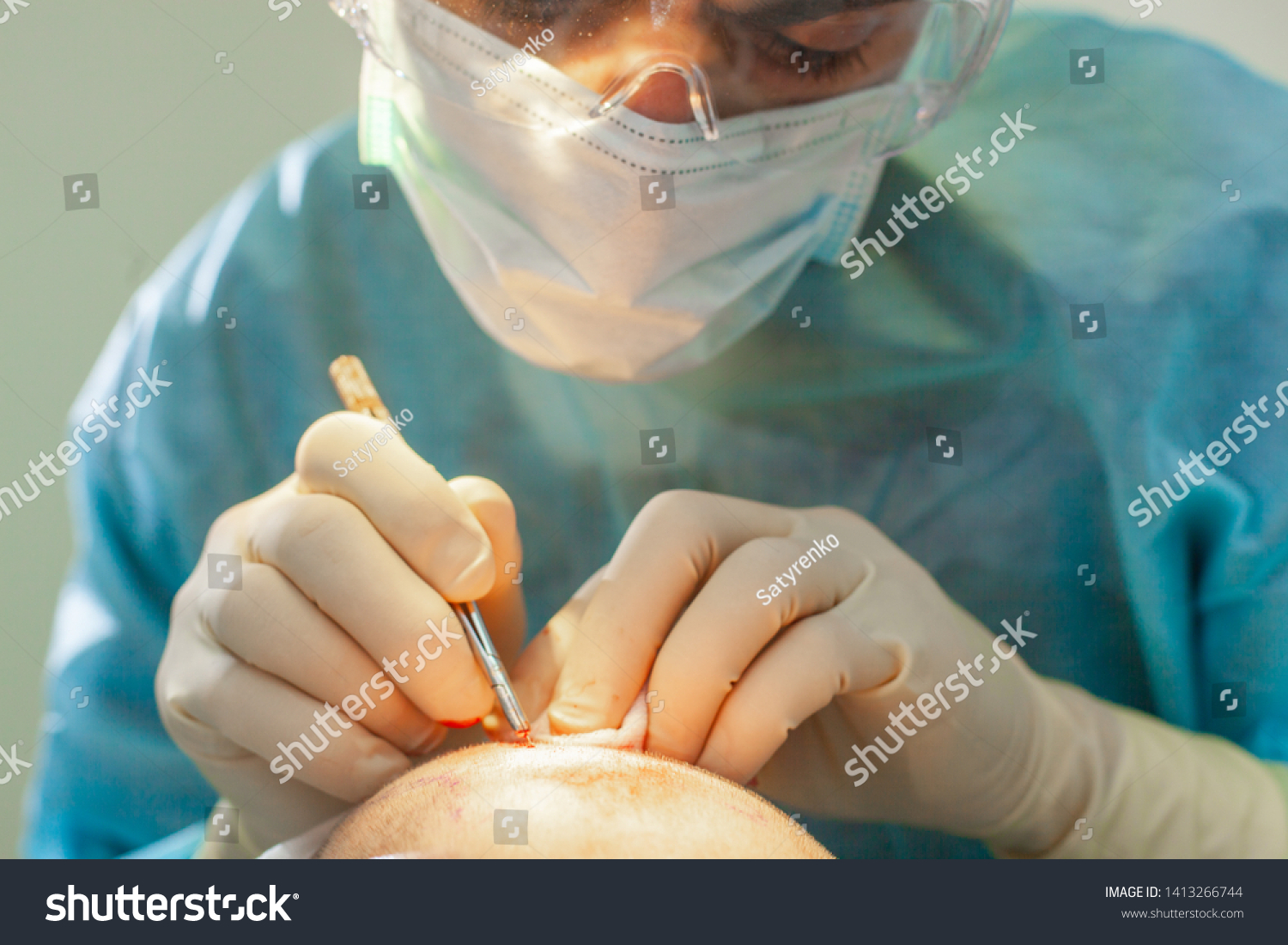 Baldness treatment. Hair transplant. Surgeons in the operating room carry out hair transplant surgery. Surgical technique that moves hair follicles from a part of the head. #1413266744