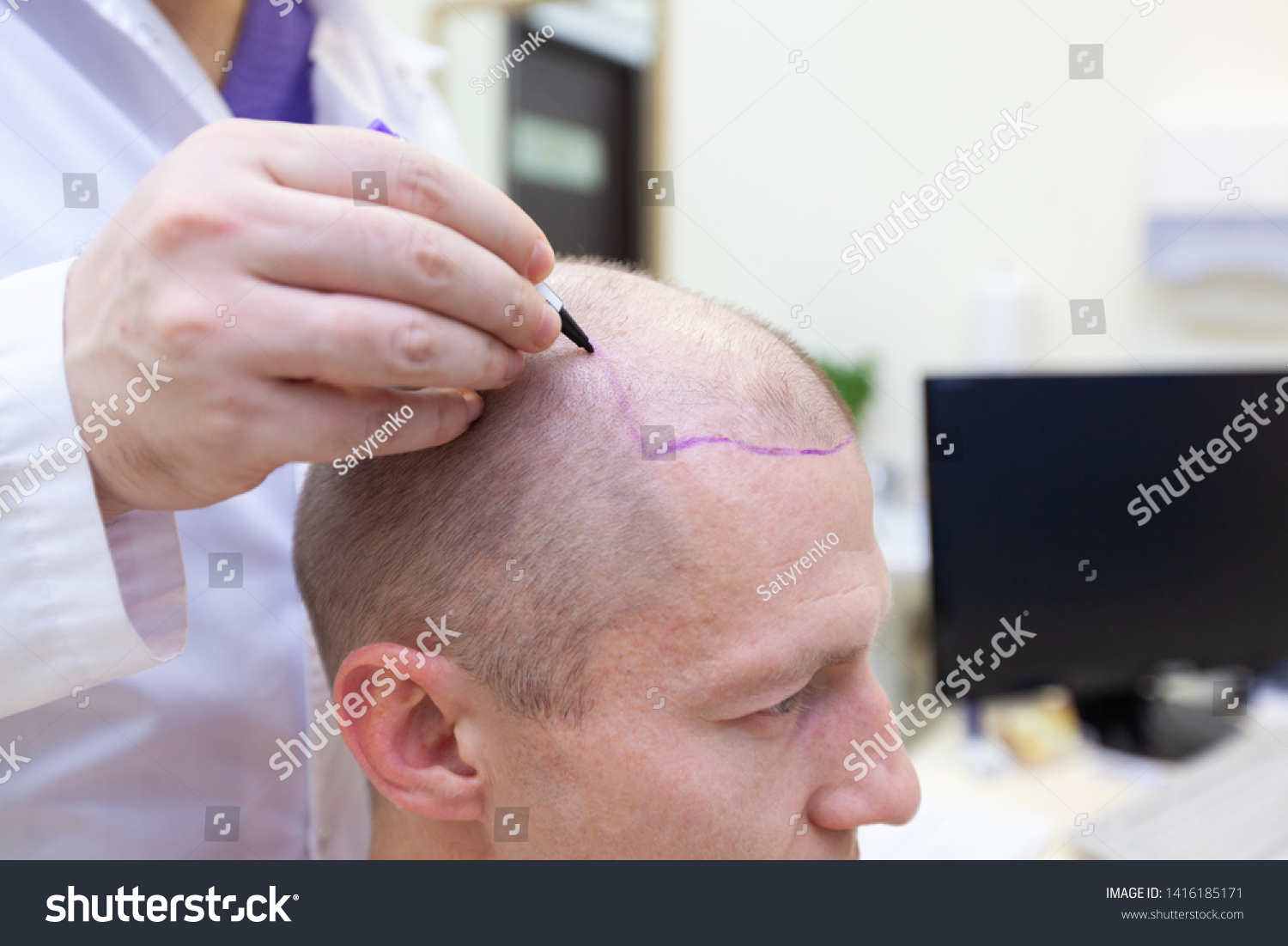 Baldness treatment. Patient suffering from hair loss in consultation with a doctor. Preparation for hair transplant surgery. The line marking the growth of hair. The patient controls the marking in #1416185171