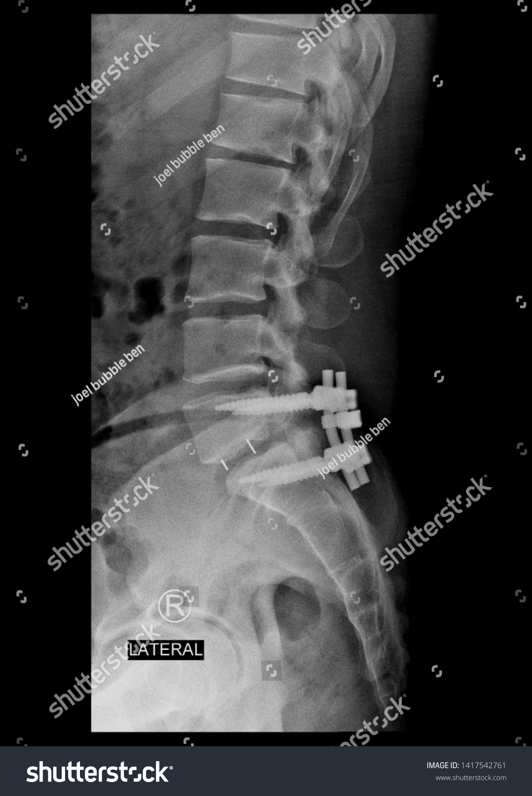 film x-ray lumbar spine radiograph showing - Royalty Free Stock Photo ...