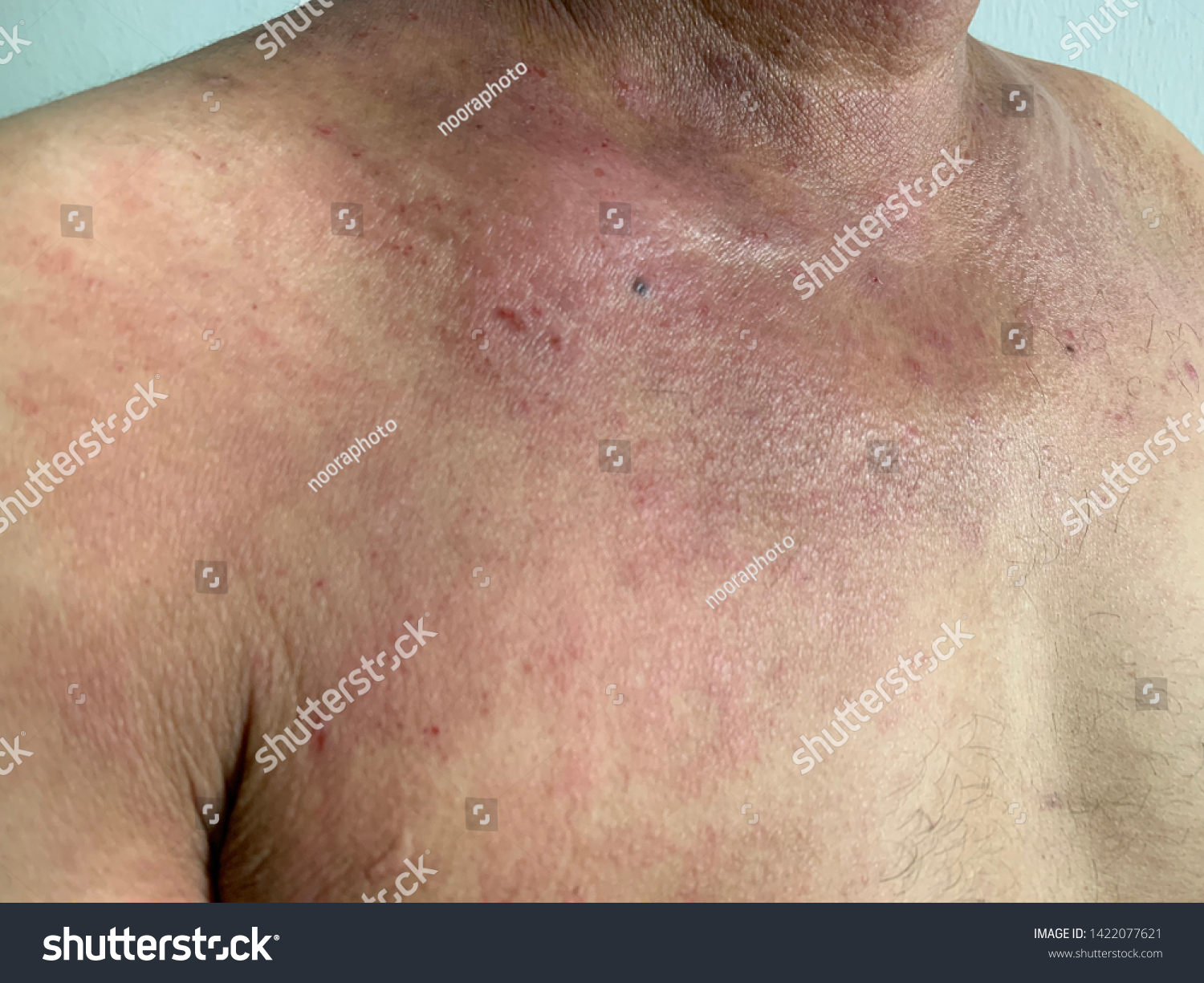 Close Up Photo Of Upper Chest Area Of Patient Royalty Free Stock